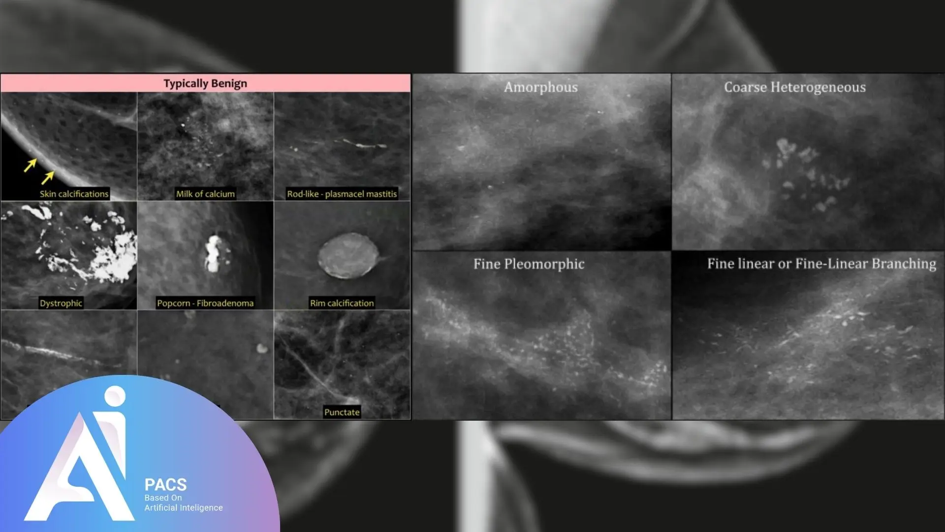 ٰImage showcasing various types of breast calcifications on mammography, sonography including typically benign patterns like skin calcifications, milk of calcium, and fibroadinoma, as well as suspicious patterns such as amorphous and fine pleomorphic calcifications.