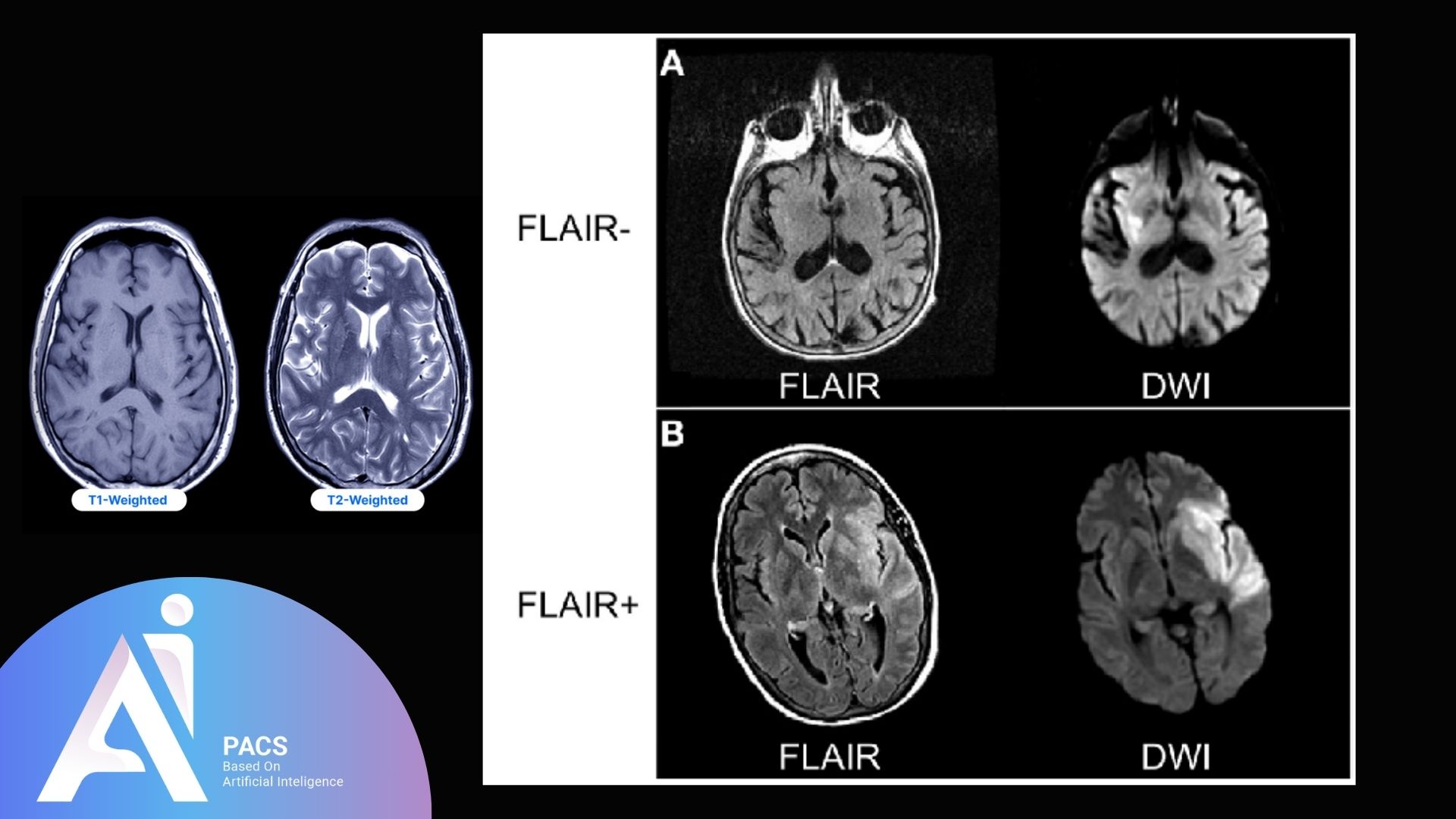 A comparison of brain MRI sequences, showing T1-weighted, T2-weighted, FLAIR-, FLAIR+, and DWI imaging, to highlight differences in brain tissue visualization.