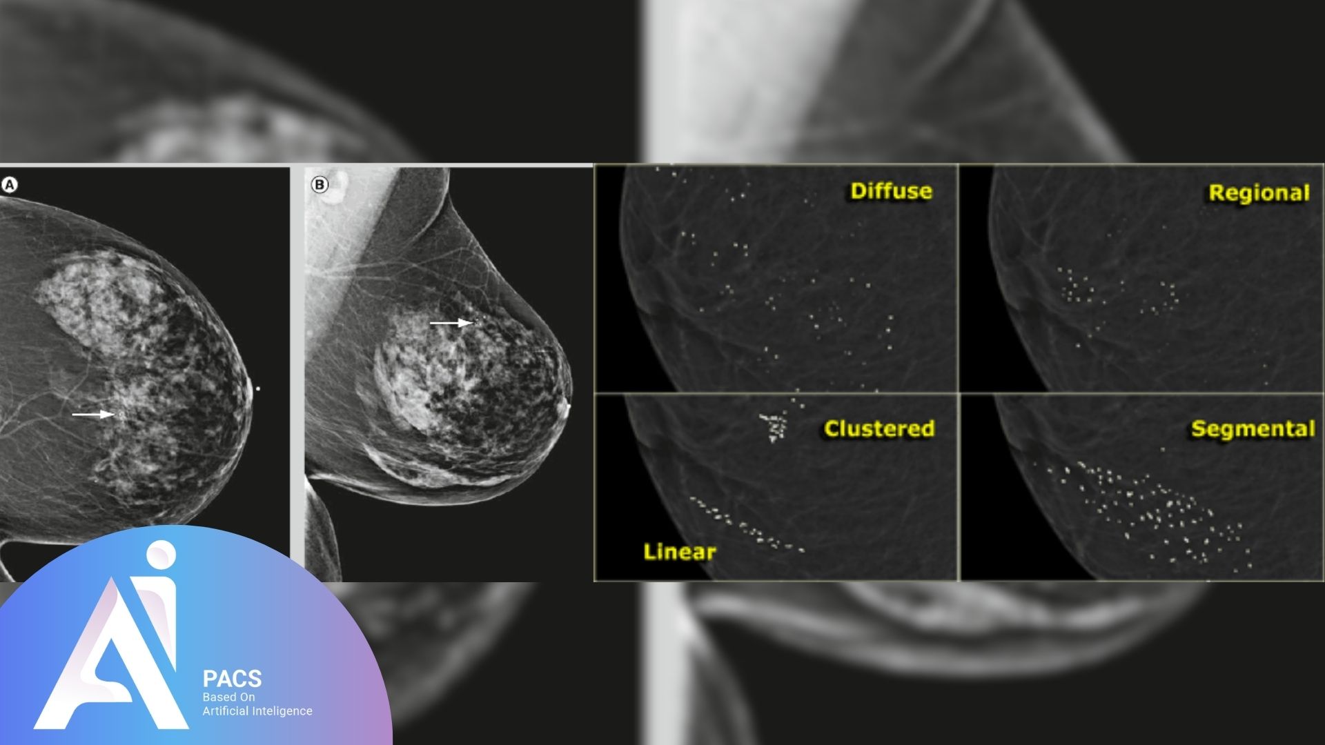 Breast mammography images highlighting different patterns of calcifications including diffuse, regional, clustered, and segmental calcifications, with specific indications marked for further clinical evaluation.