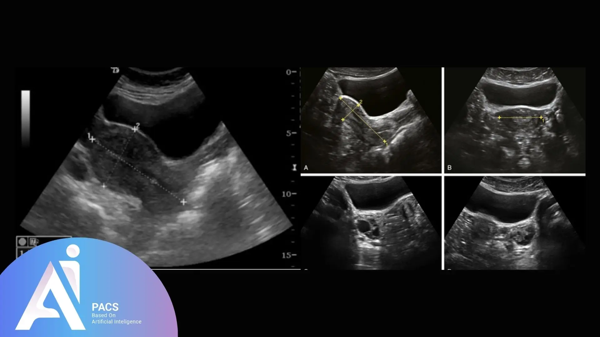 Normal female pelvic ultrasound showing typical anatomical structures, including the uterus and ovaries, with measurement markers for clinical reference.