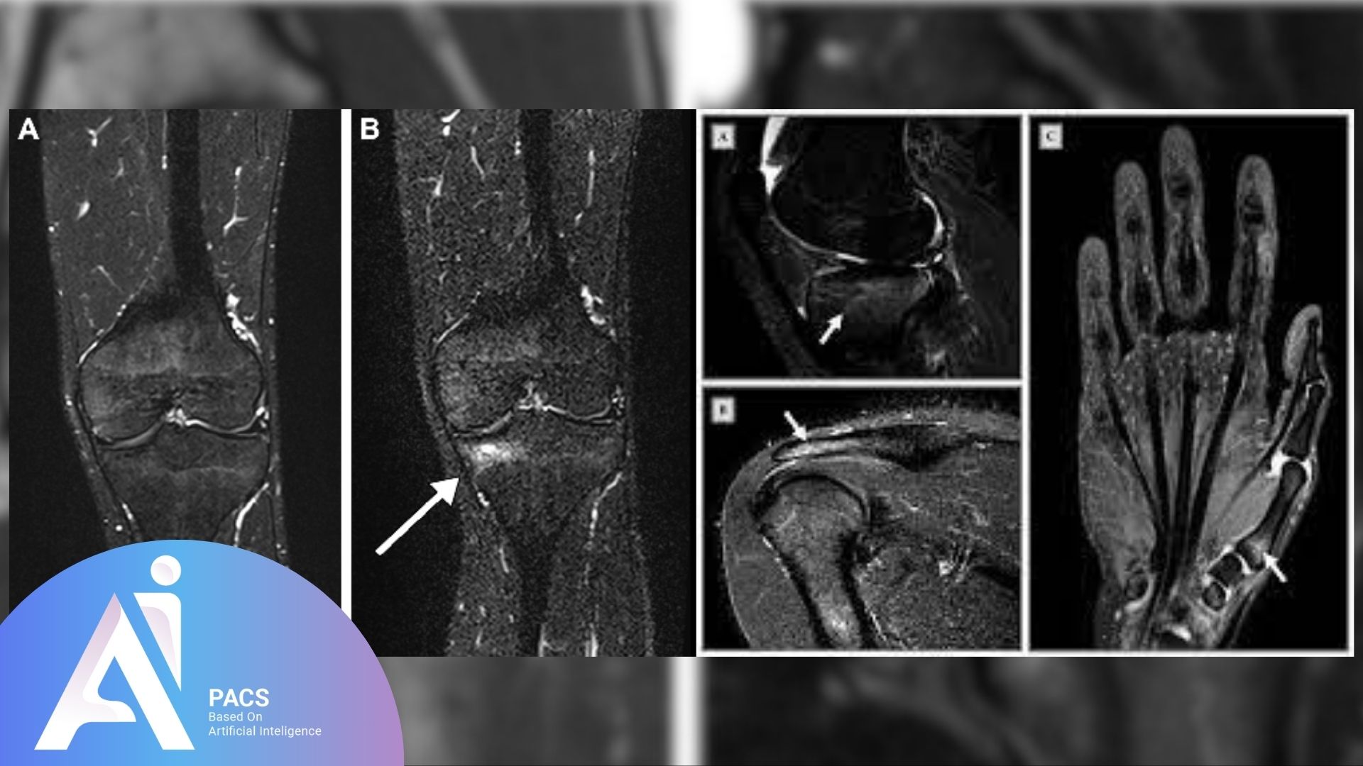 MRI scans of knee, shoulder, and hand showing bone marrow edema in athletes, used for AI-based diagnostic review by AI PACS.