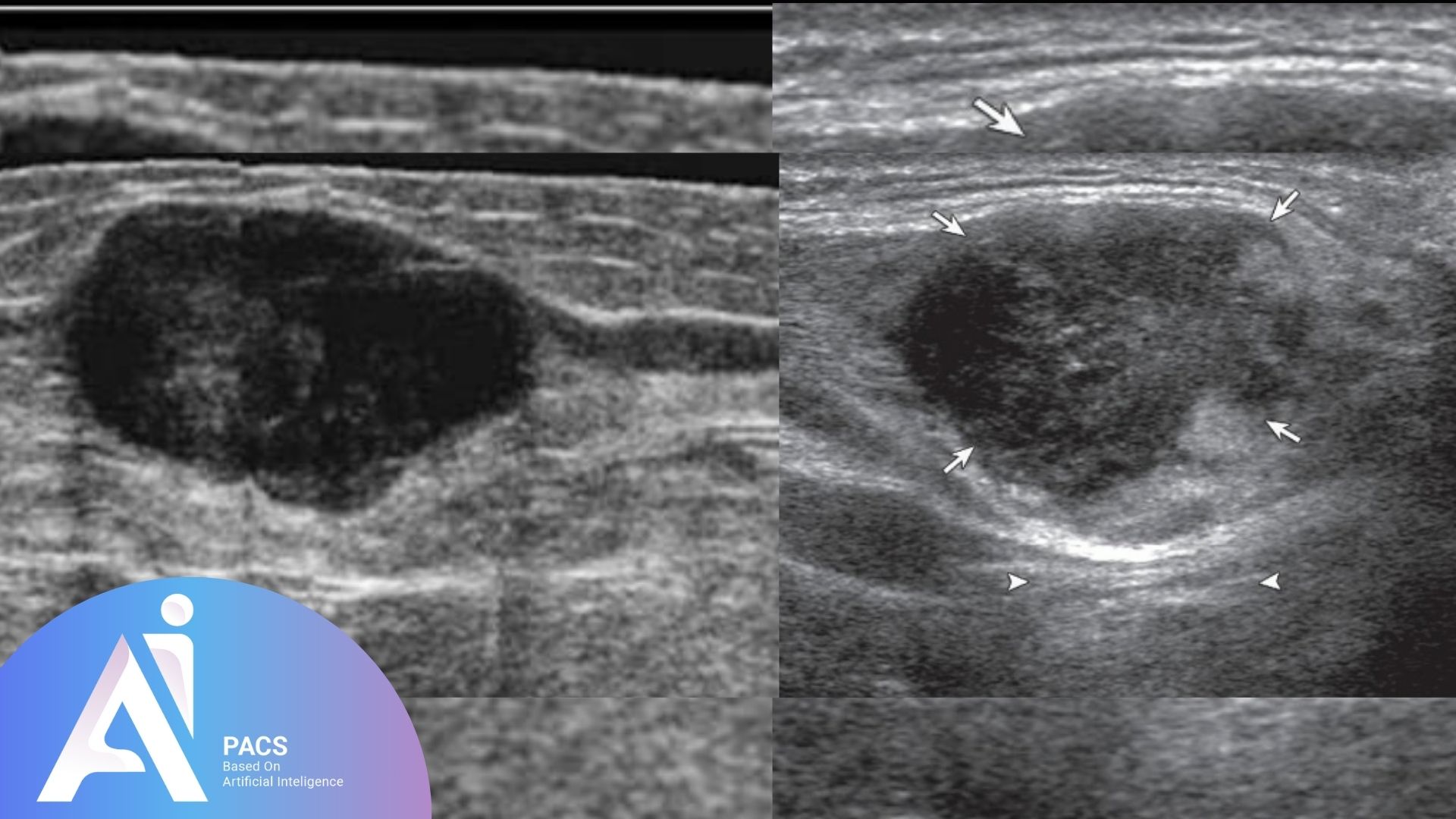 ultrasound scan of soft tissue hypoechoic masses, highlighting the appearance of a potential tumor or cyst with clear indications marked by arrows and arrowheads for diagnostic evaluation.