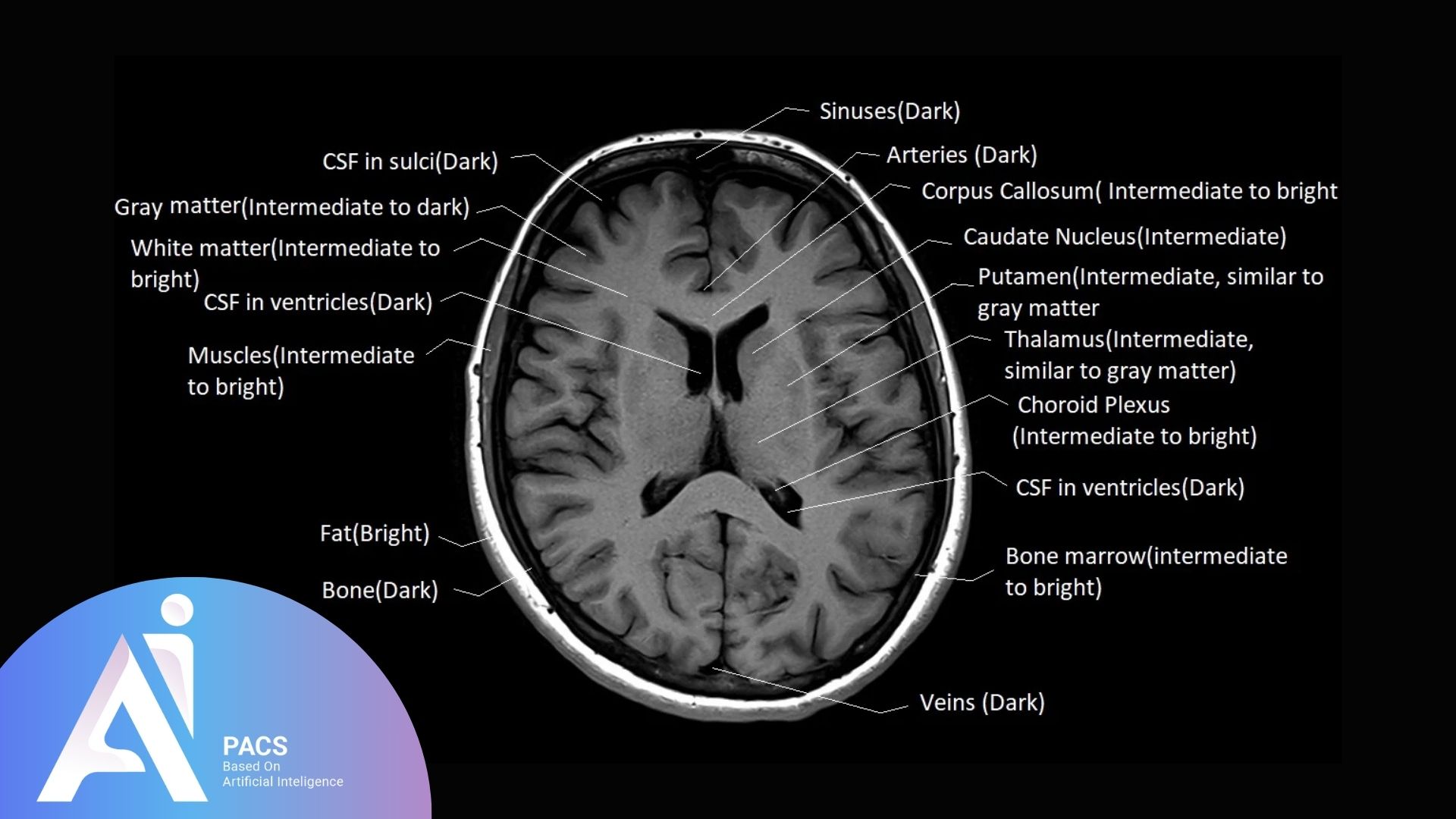 An annotated brain MRI image displaying various brain tissues and structures, including CSF, gray matter, white matter, and arteries, with their corresponding signal intensities.