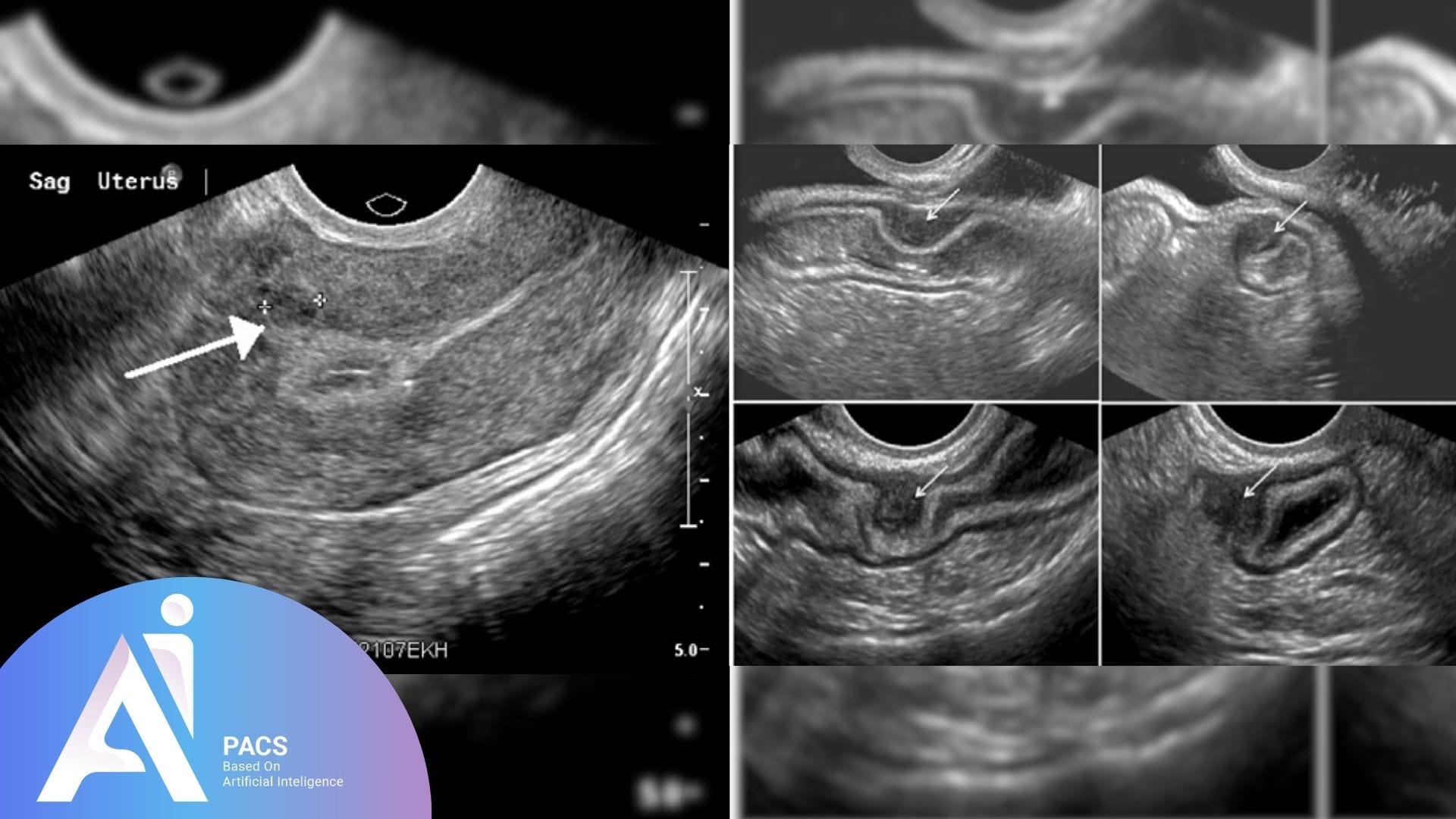 Transvaginal ultrasound showing hypoechoic lesions in the uterus, with detailed views of the lesions marked by arrows, relevant for gynecological diagnosis and analysis.