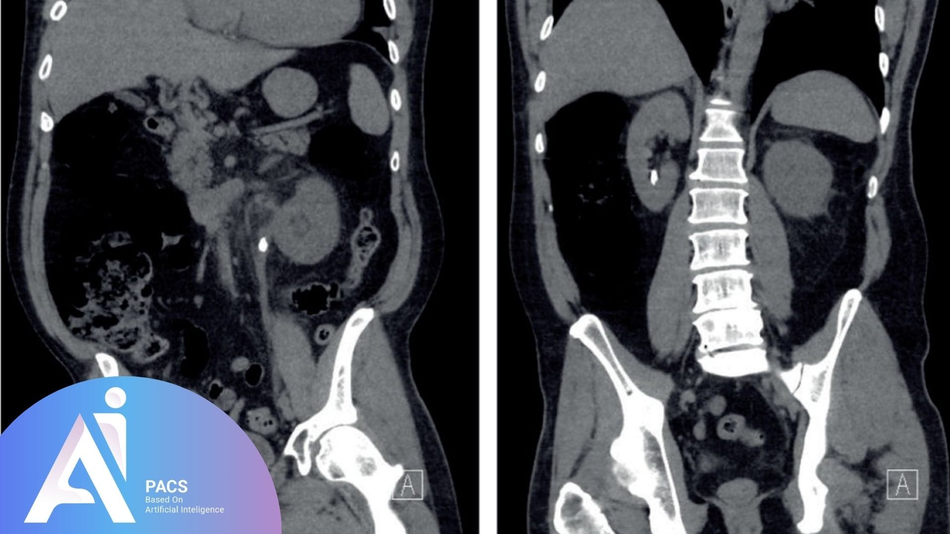 Coronal CT scan images of the abdomen and pelvis showing bilateral kidneys. The right image reveals a hyperdense renal stone within the left kidney, and spinal structures are clearly visible. This scan helps assess the location and extent of kidney stones and their impact on surrounding anatomy.