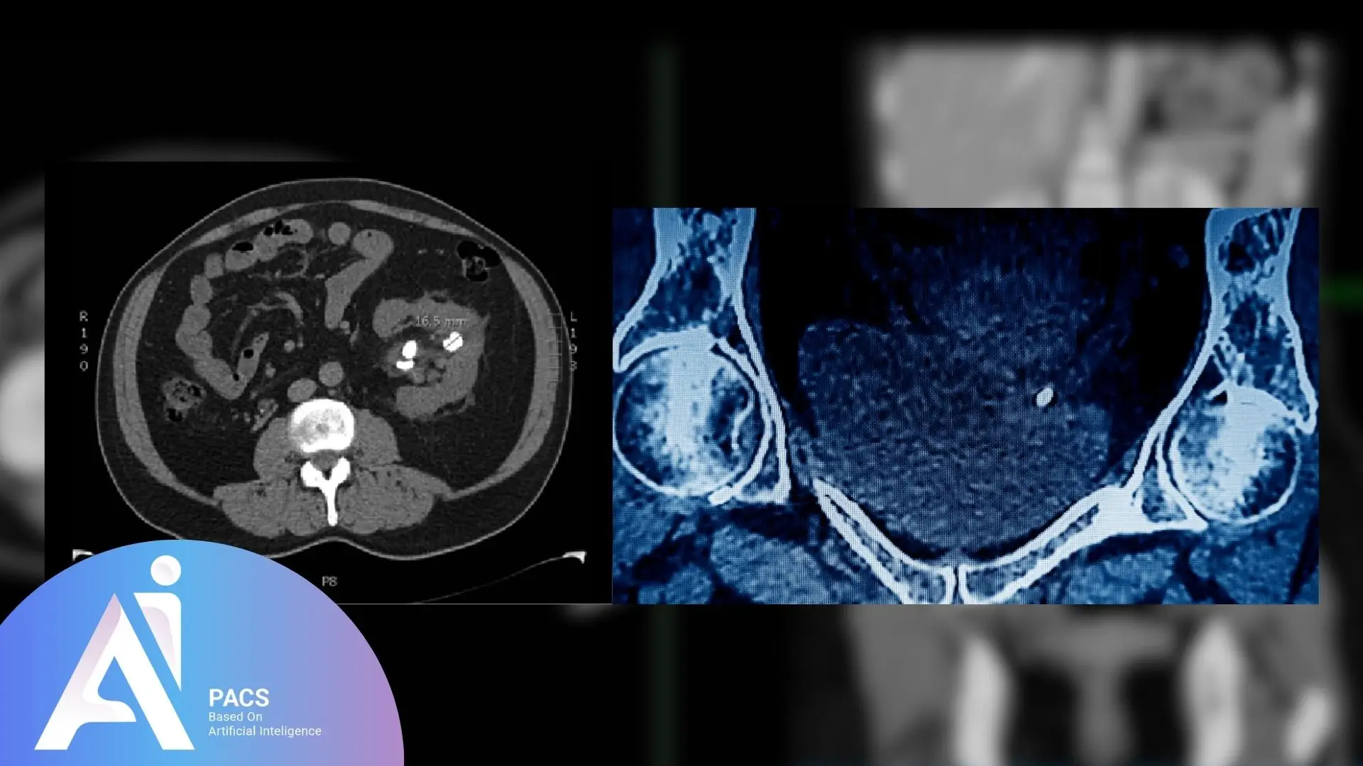 Axial and sagittal CT images of the abdomen displaying kidney and ureteral stones. The left image highlights a calcified stone measuring 16.5 mm in the renal pelvis. The right image shows a focused view of a ureteral stone on contrast-enhanced CT. These findings are crucial for diagnosing the size and position of urinary tract stones.