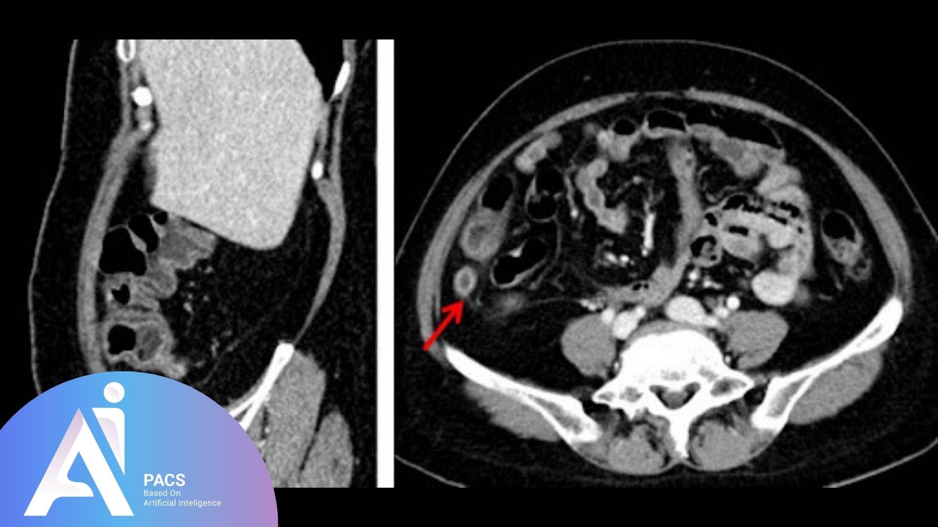CT scan showing a cross-sectional view of the abdomen with a red arrow pointing to the inflamed appendix, indicating acute appendicitis.