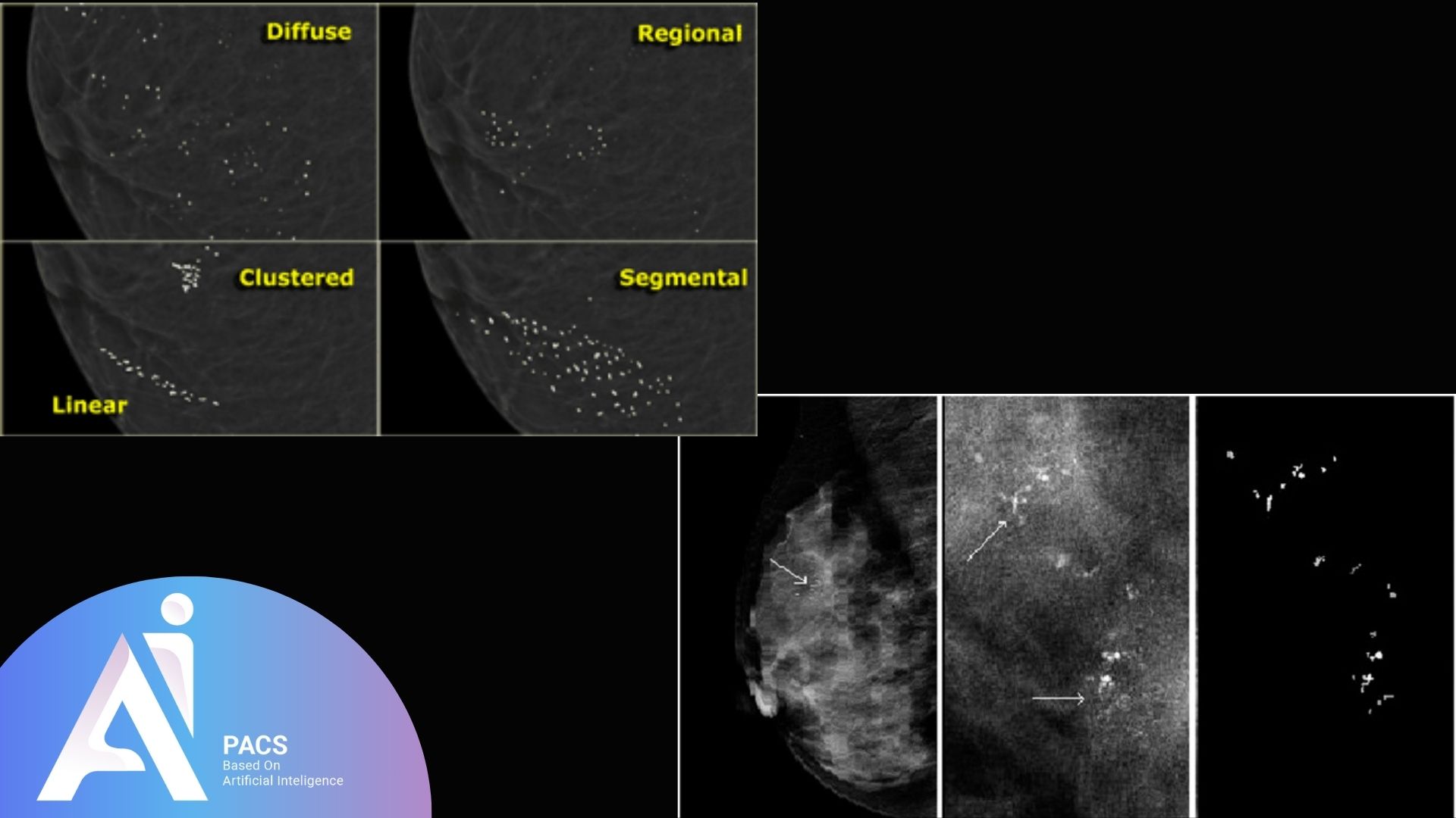 different distribution patterns of breast calcifications and microcalcifications, including diffuse, regional, clustered, segmental, and linear.