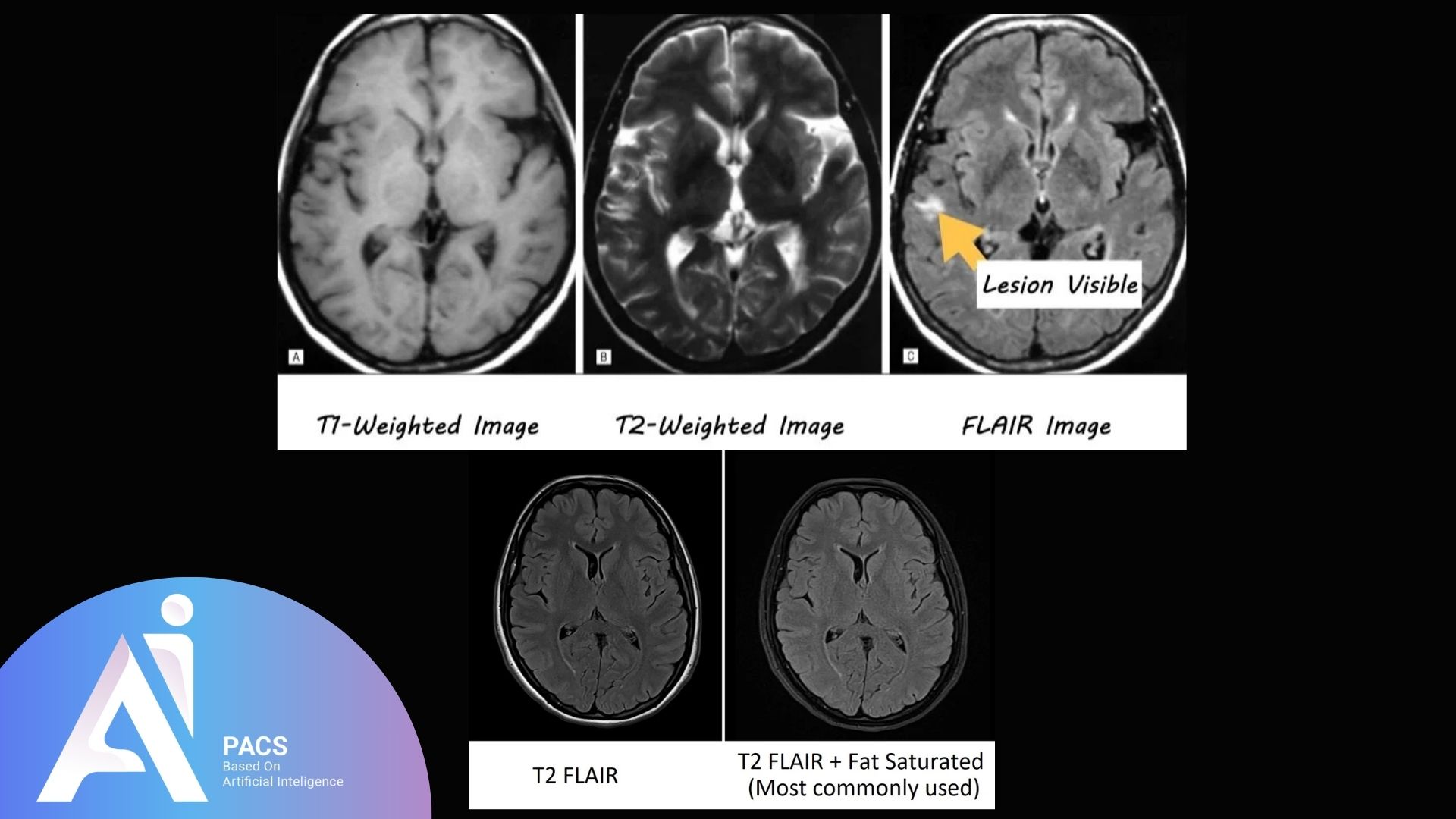 MRI images showcasing T1-weighted, T2-weighted, FLAIR, T2 FLAIR, and T2 FLAIR fat-saturated sequences, highlighting lesion visibility for neuroimaging analysis.