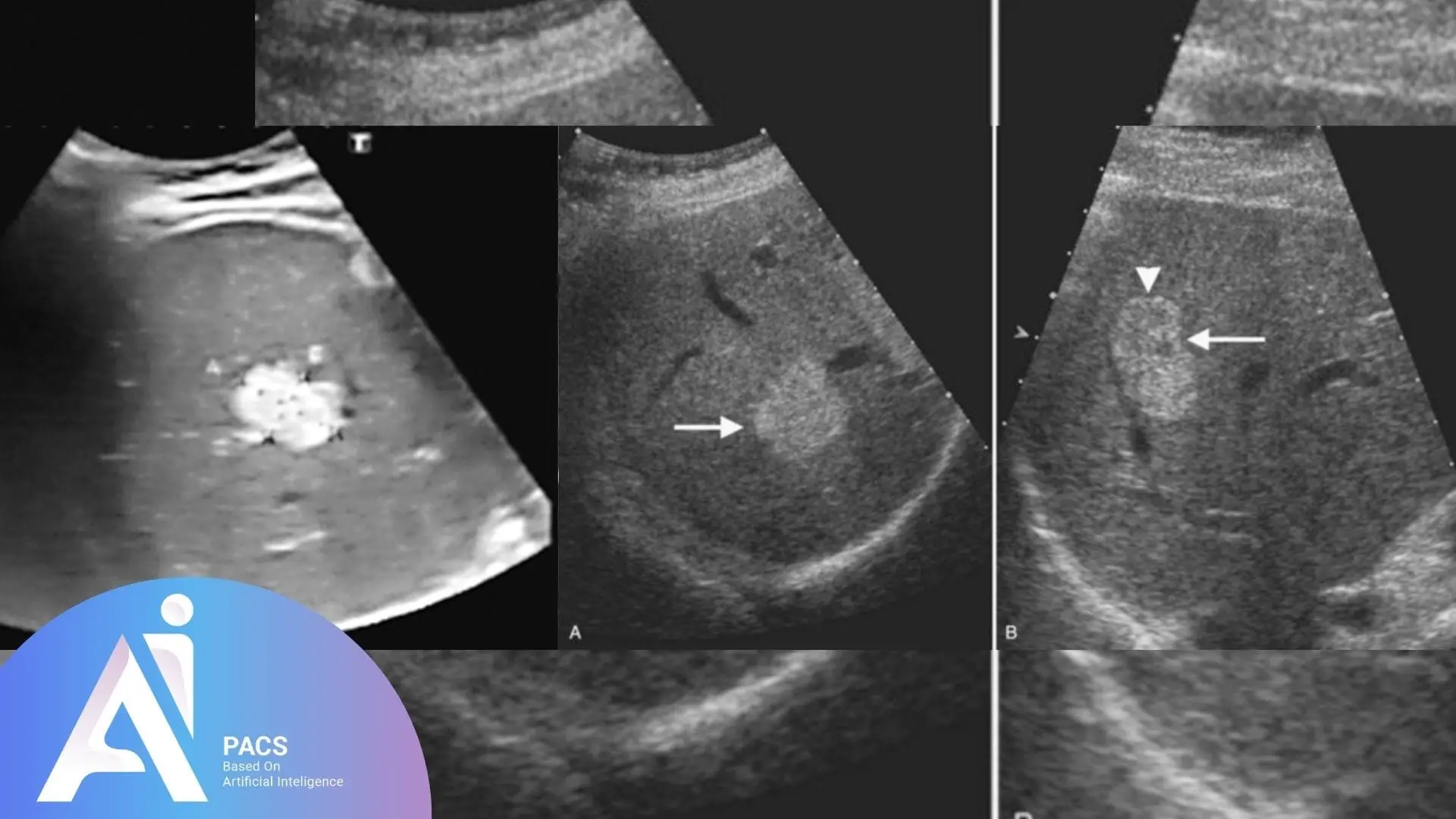 Ultrasound image displaying an Intense hyperechoic lesion in the liver with arrows pointing to the lesion and surrounding features for better visualization.