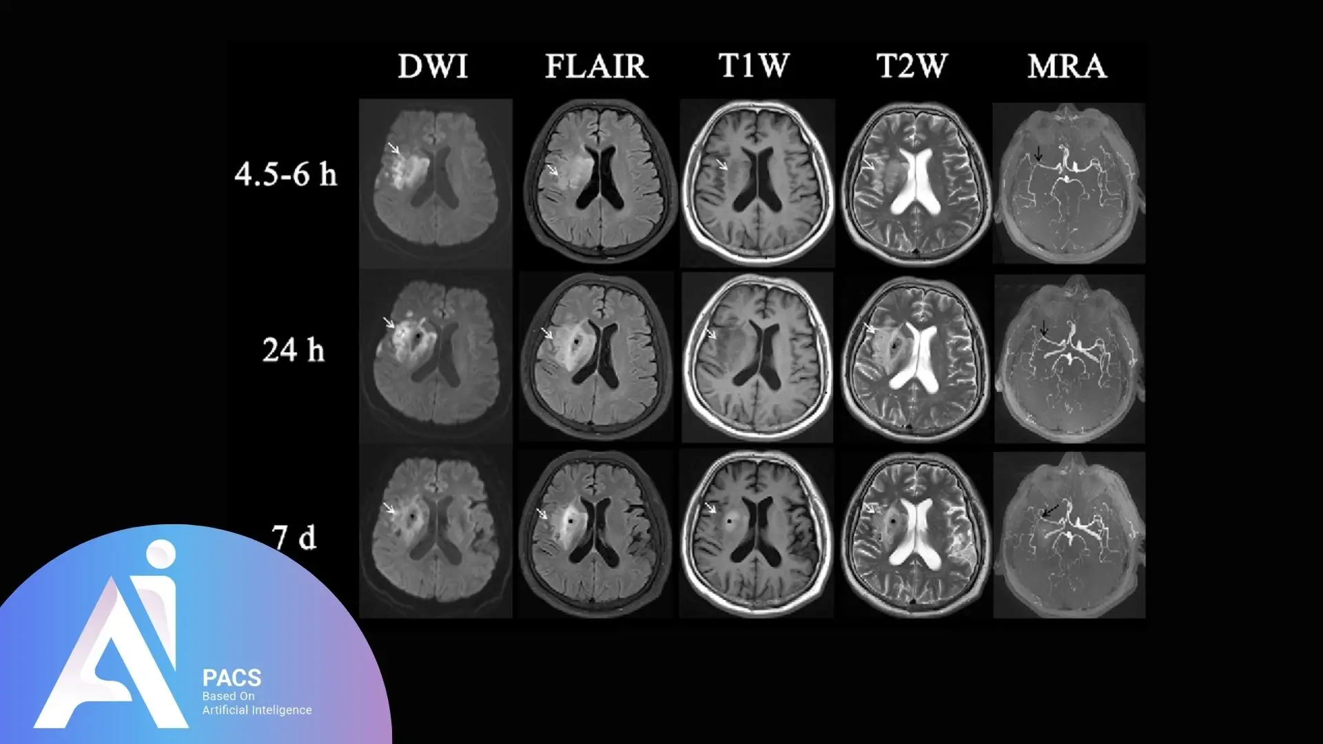 MRI series depicting DWI, FLAIR, T1W, T2W, and MRA sequences at different time points (4.5-6 hours, 24 hours, 7 days), showing stroke evolution and vascular changes in the brain.