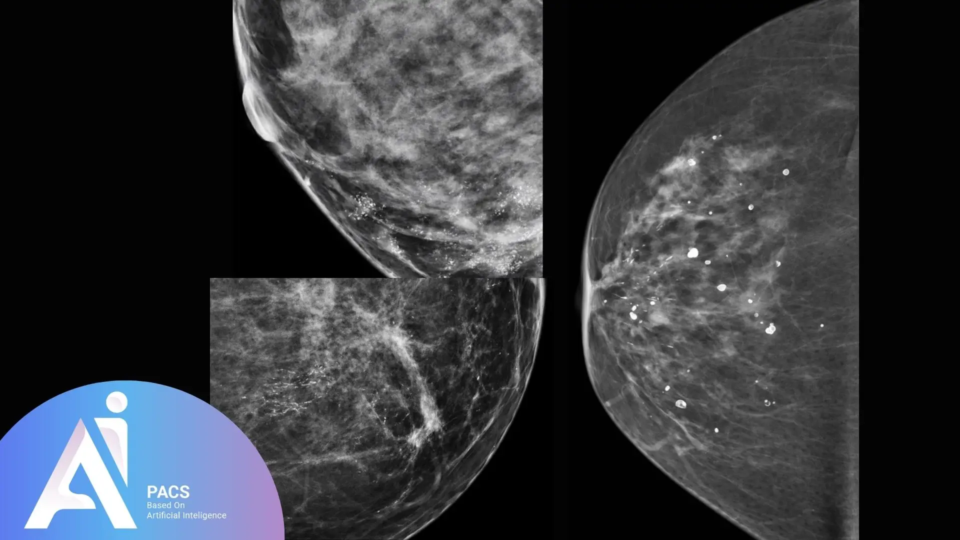 breast microcalcifications of varying shapes and densities, used to assess the risk of breast cancer
