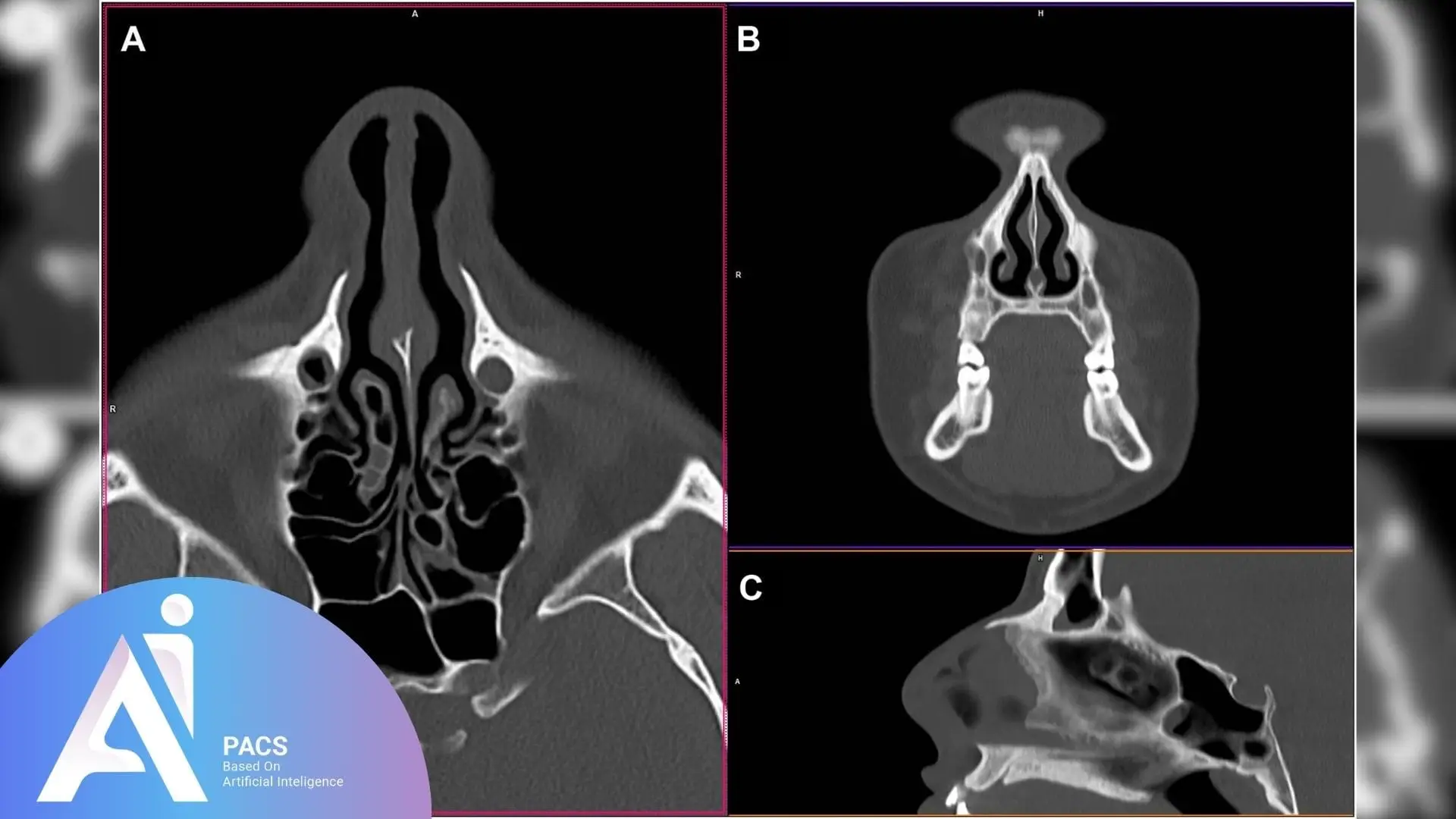 A CT scan of the nasal cavity shown in three different views: Coronal (A), Sagittal (B), and Axial (C). The scan displays the structure of the nasal passages, sinuses, and surrounding bones. 