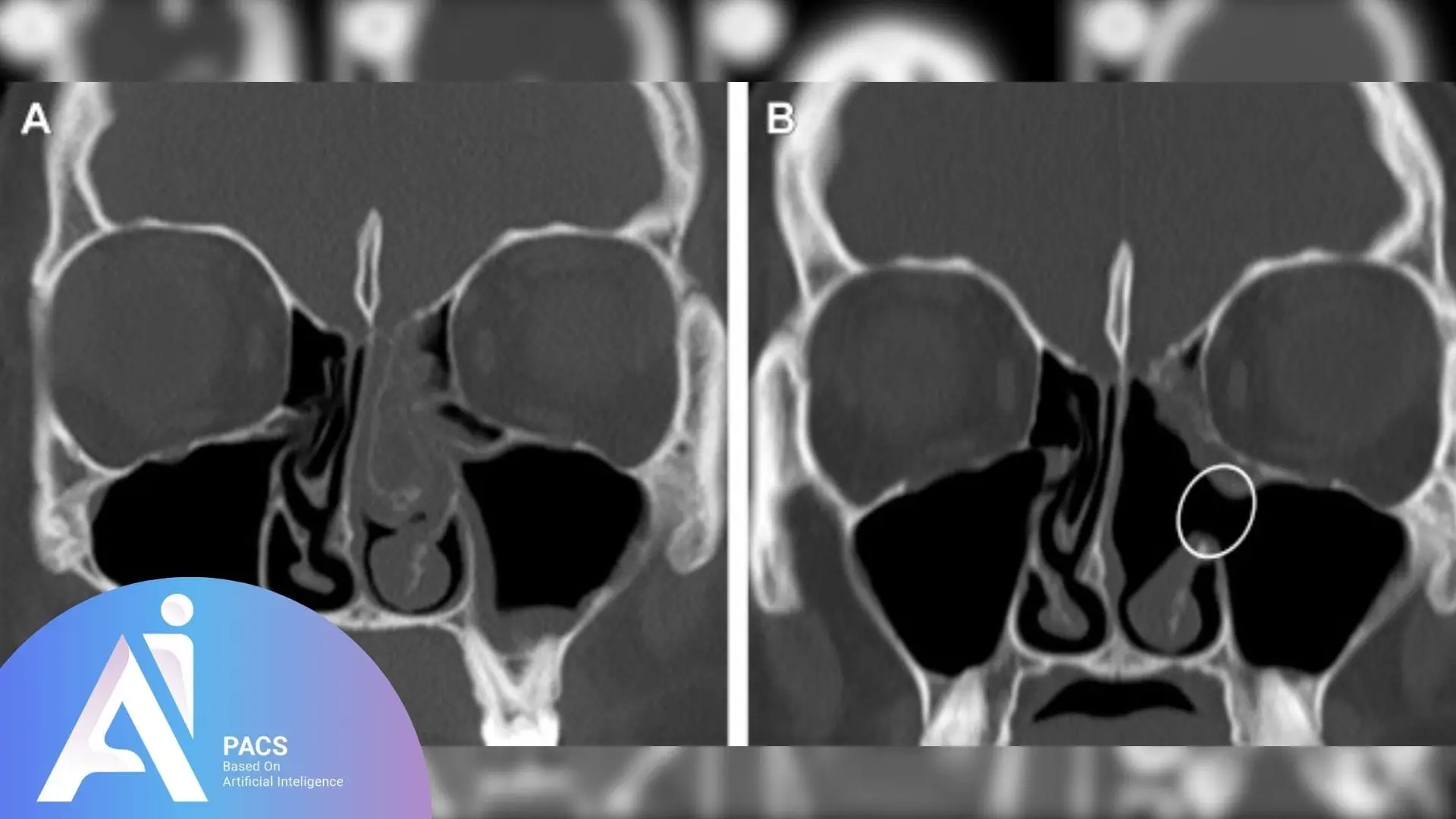  CT scan of the nasal area in two views: Coronal (A) and a closer, focused view (B). The second image highlights a small abnormality or area of interest inside the nasal cavity, indicated by a circular marking, which may be relevant for medical assessment related to nasal reconstruction or surgery.
