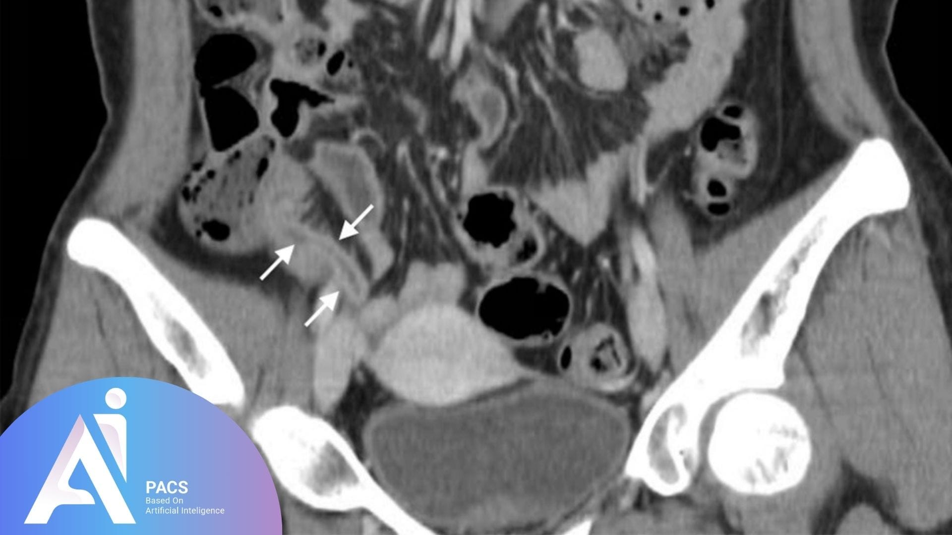 CT scan showing a sagittal view of the abdomen with multiple arrows pointing to the inflamed appendix, suggesting the presence of acute appendicitis.