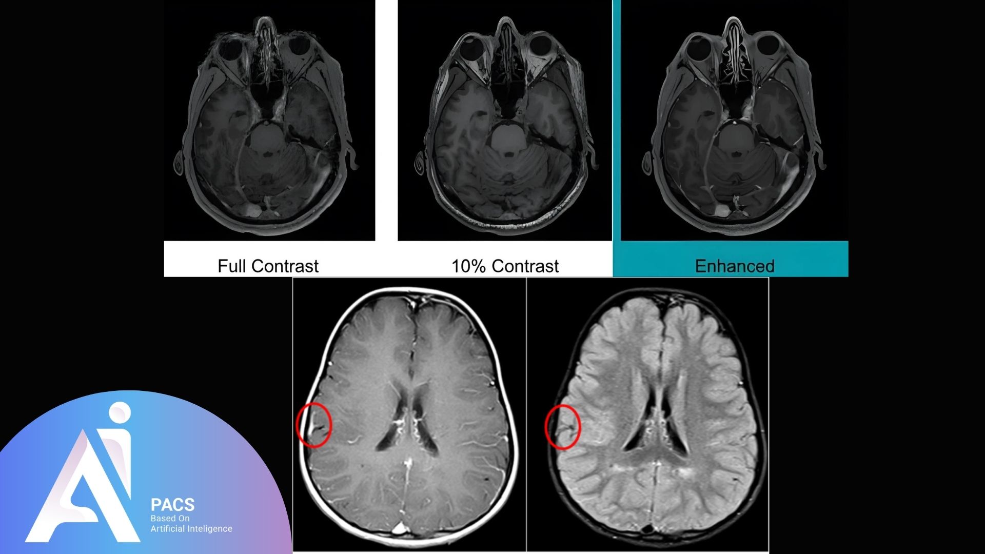 Brain MRI with varying contrast levels (full contrast, 10% contrast, and enhanced), showcasing the value of contrast-enhanced FLAIR MRI imaging for identifying abnormalities.