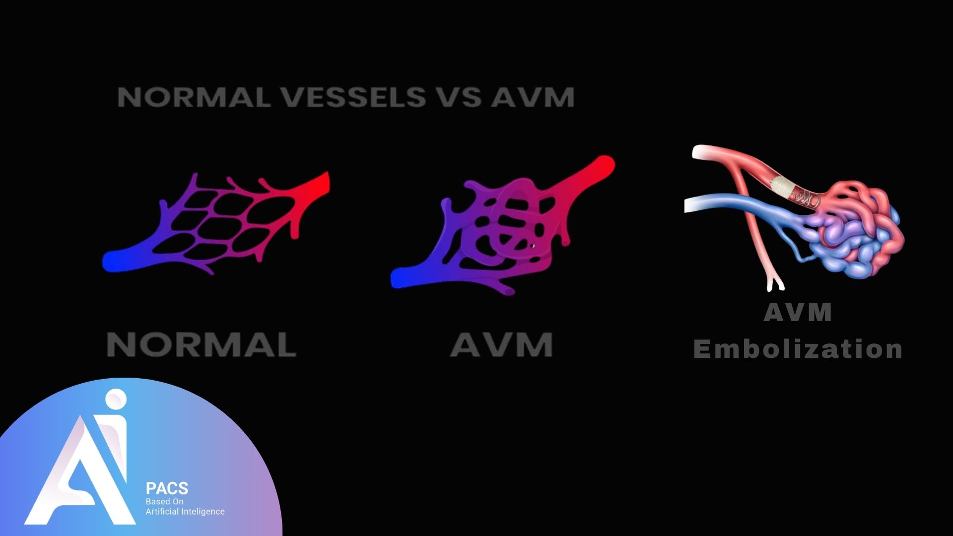 A visual comparison of normal blood vessels, arteriovenous malformation (AVM) vessels, and the embolization procedure used to treat AVMs, with highlighted areas showing the abnormal vessel network and the treatment process.