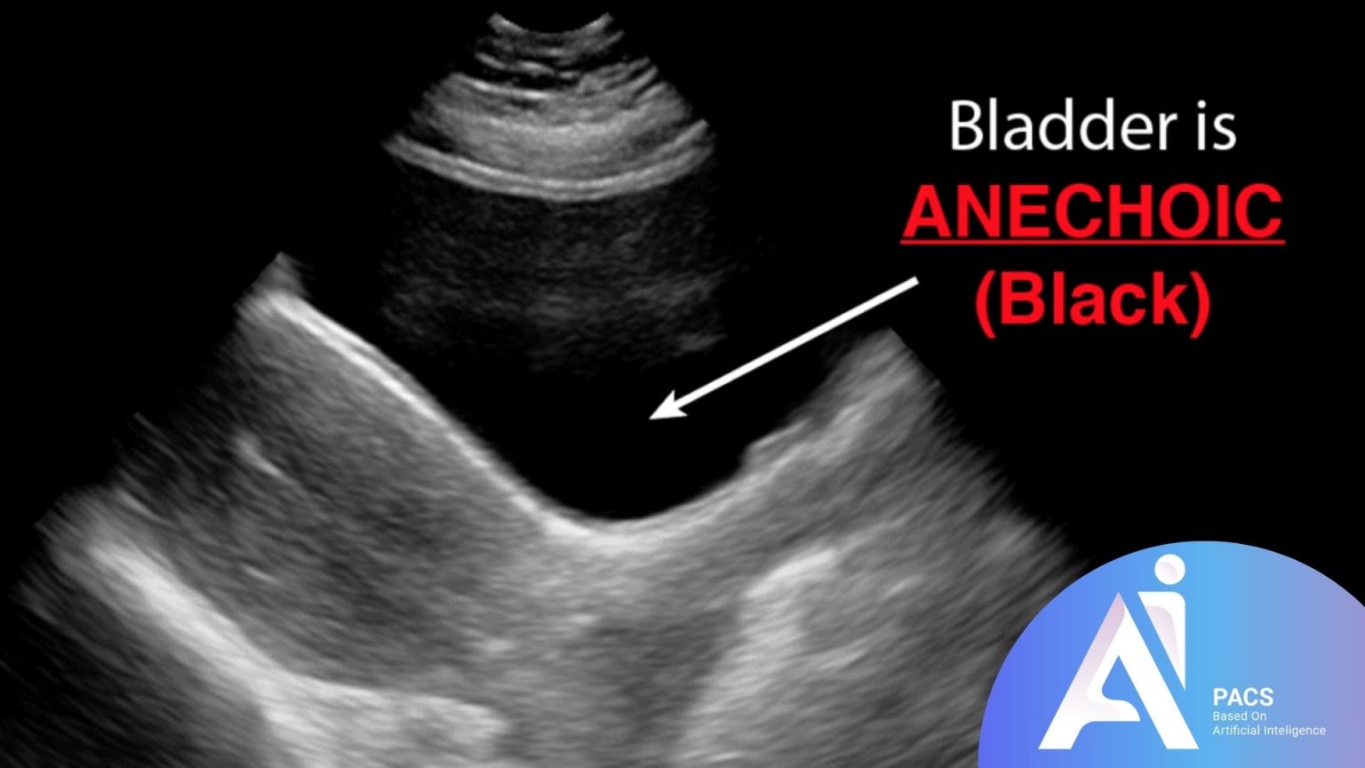 Anechoic Area on Ultrasound: What Is It?