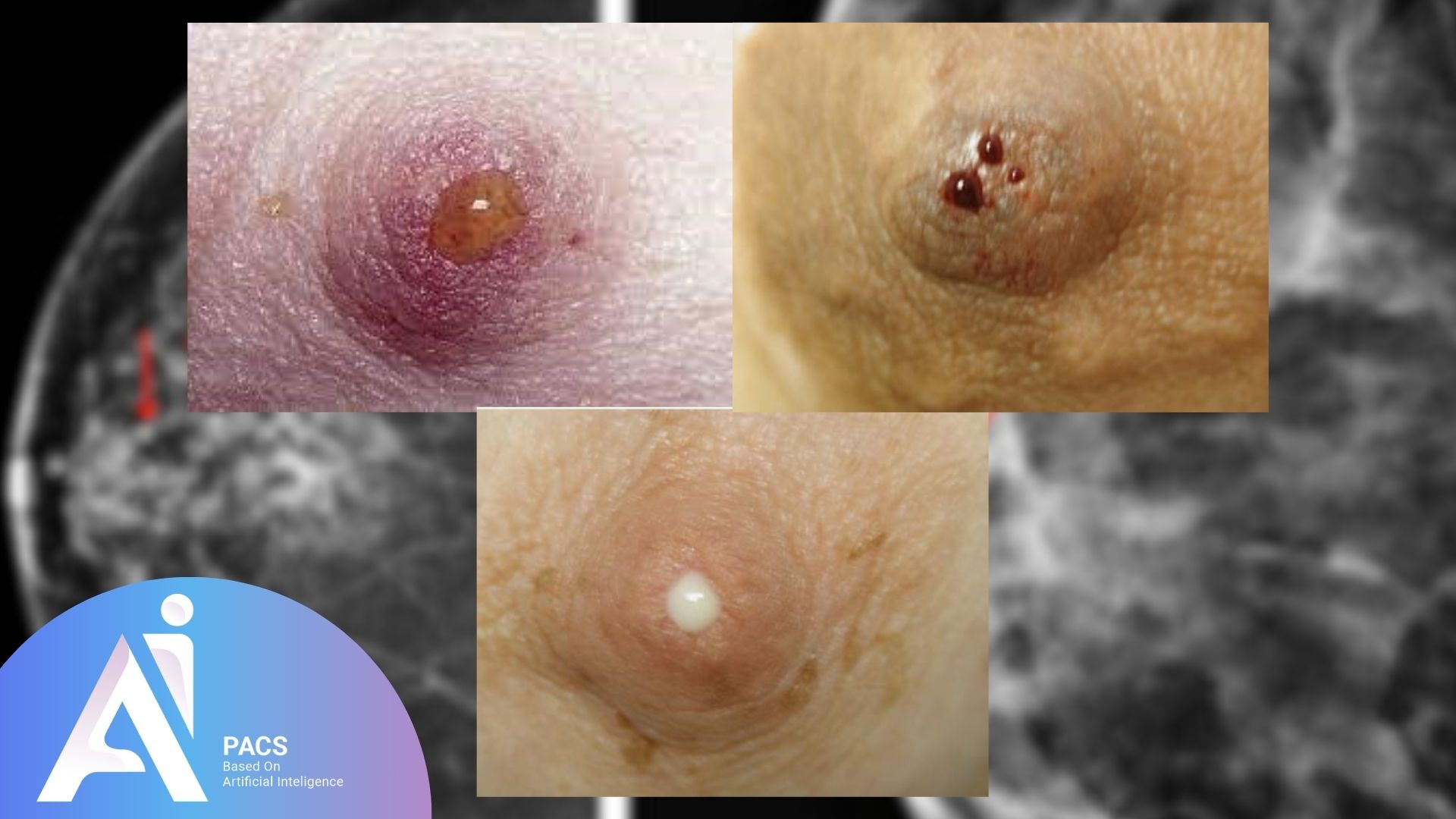 different types of nipple discharge, including clear, bloody, and milky discharges, accompanied by a mammography image in the background. These variations in nipple discharge may signal different underlying conditions that require further evaluation and diagnosis.