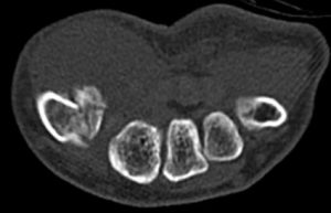 a close-up of a tooth x-ray