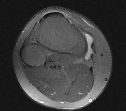 a mri of a human knee