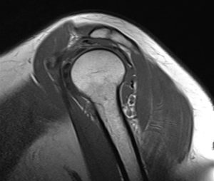 a close-up of a mri scan of a shoulder