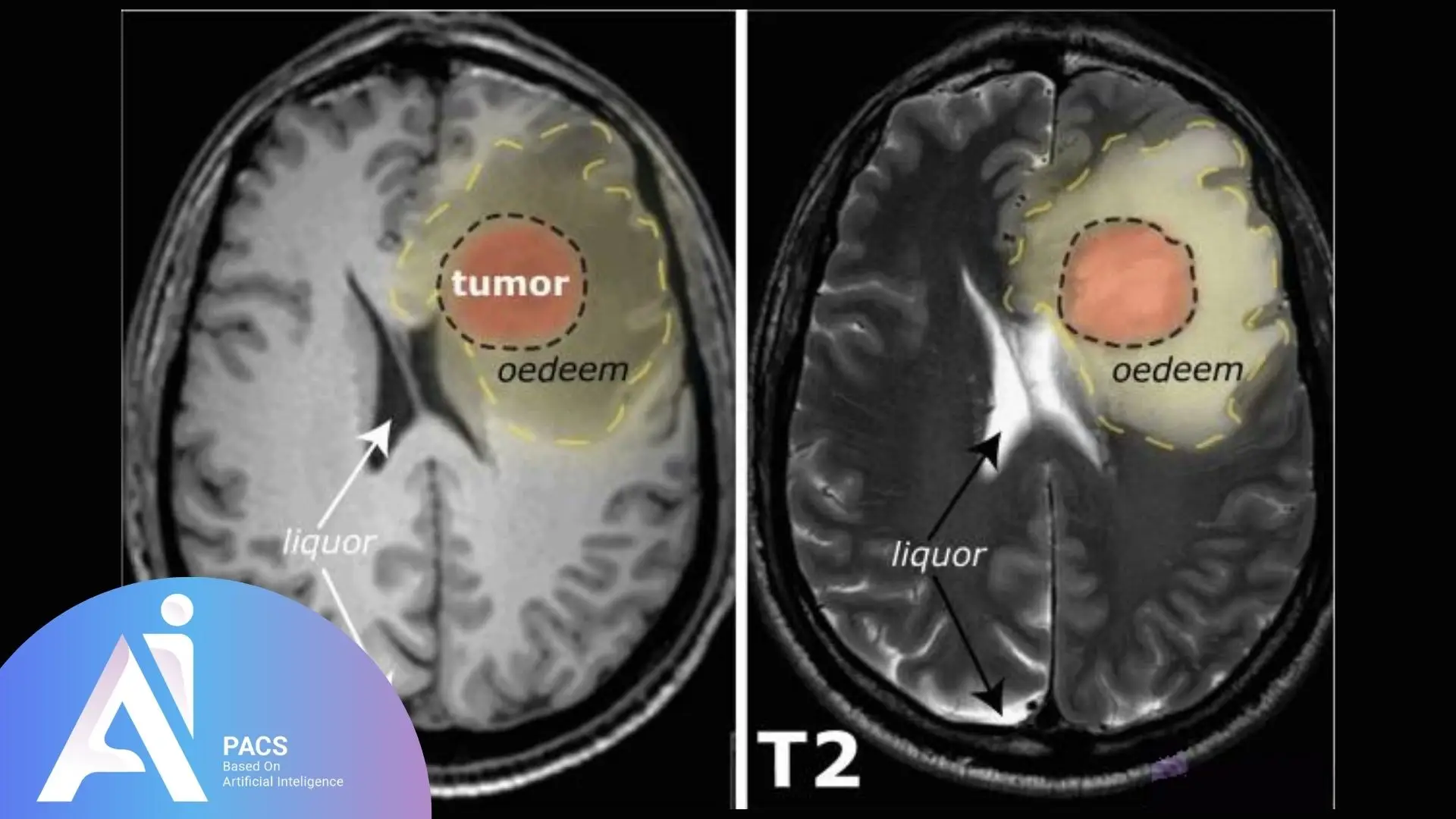 compares T2 MRI scans showing a brain tumor with surrounding edema (swelling), along with fluid areas indicated as "liquor" and the tumor outlined.