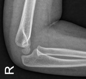 x-ray of a person's elbow