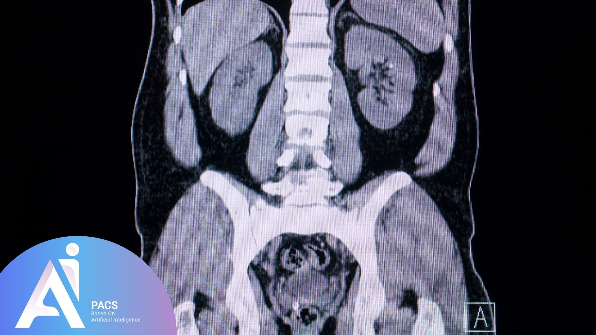 Abdominal and pelvic CT scan reading