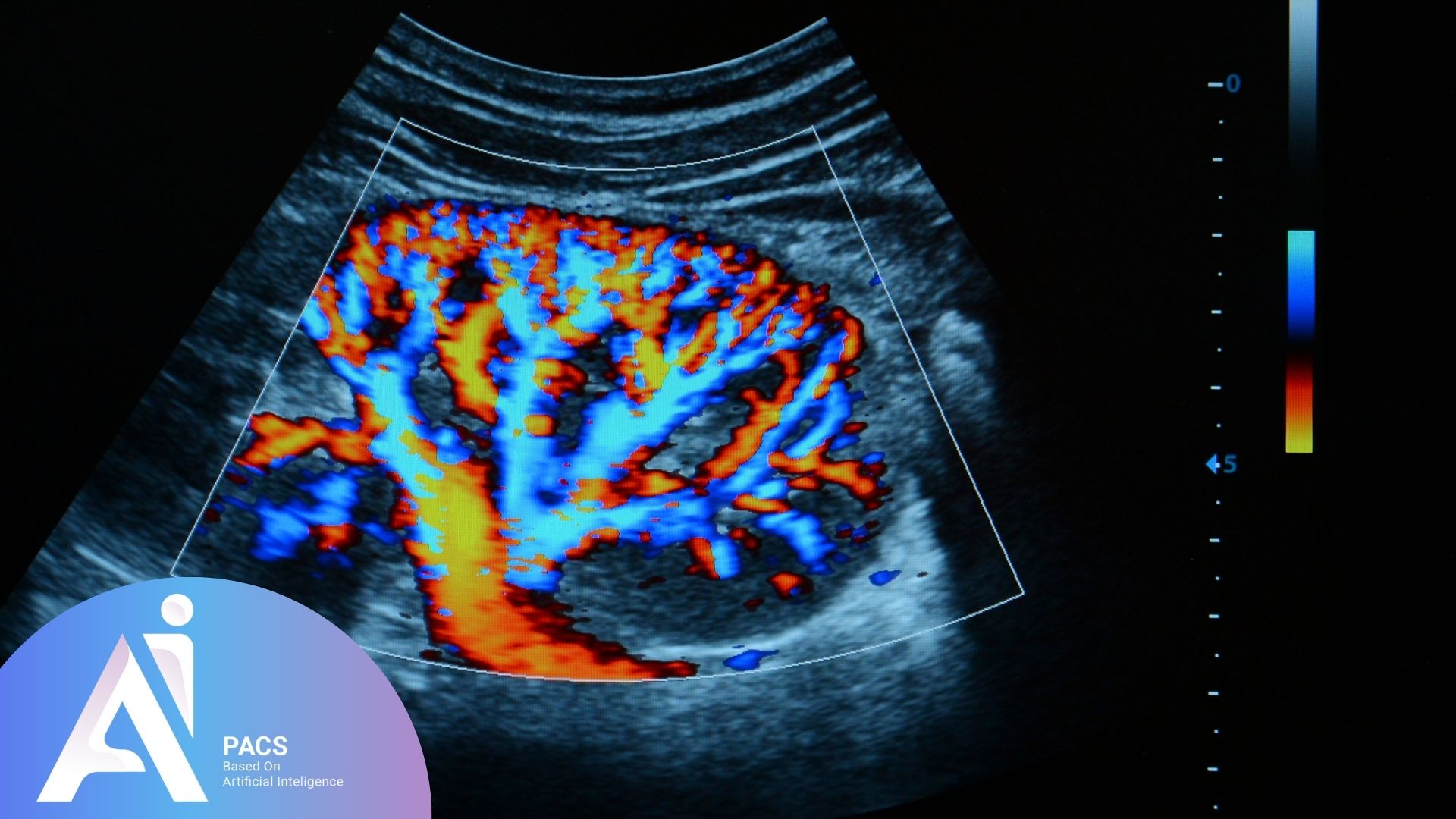 Reading Pregnancy Doppler Ultrasound