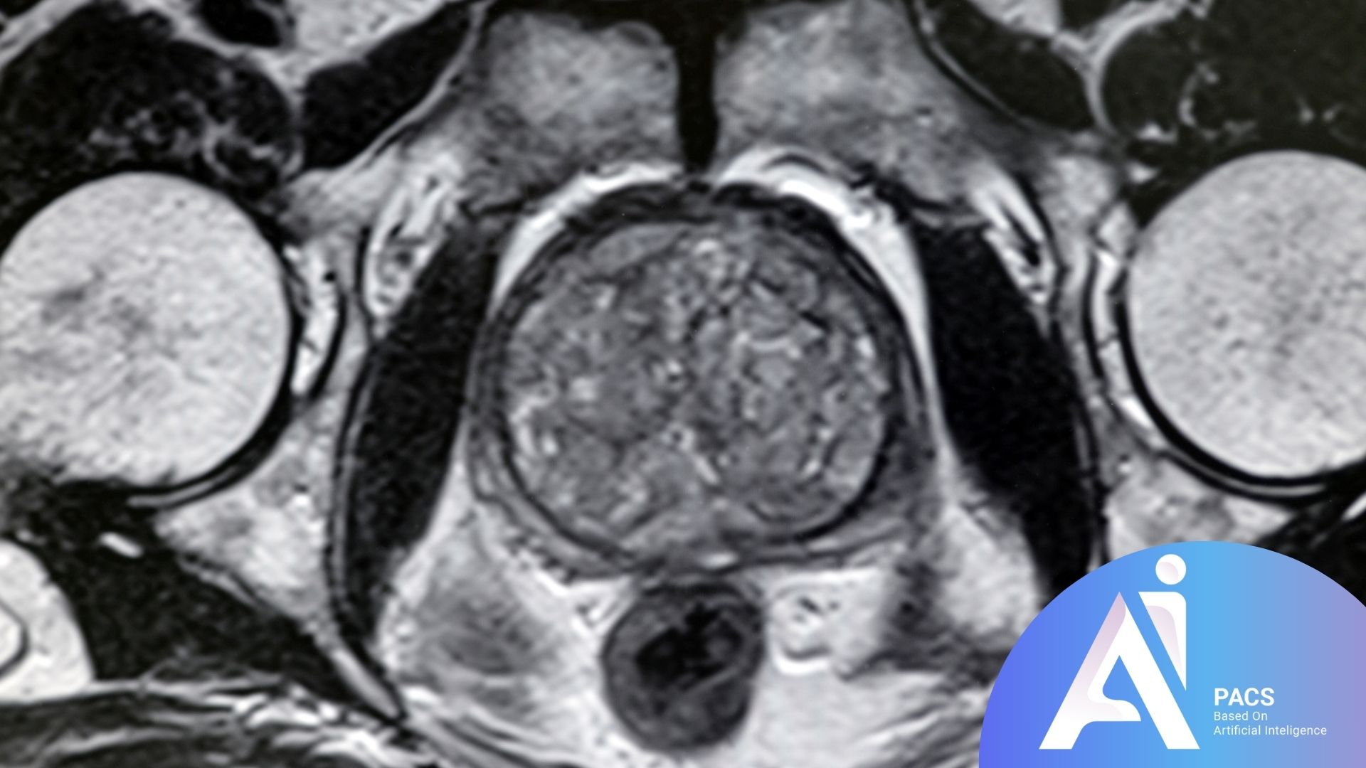 Understanding Your Prostate MRI Report