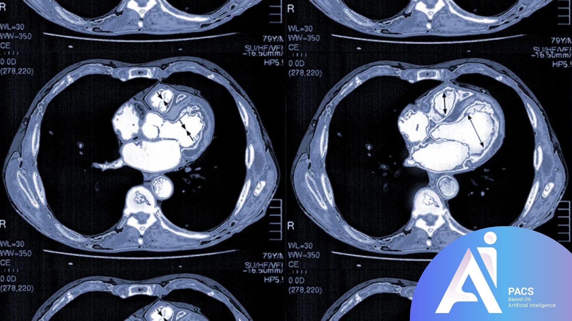 How to Interpret Your Heart CT Scan?