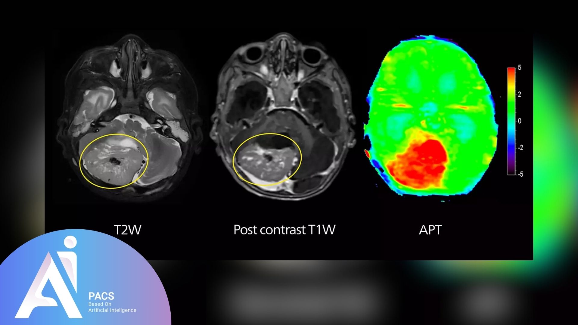 APT for grading brain tumors with MRI