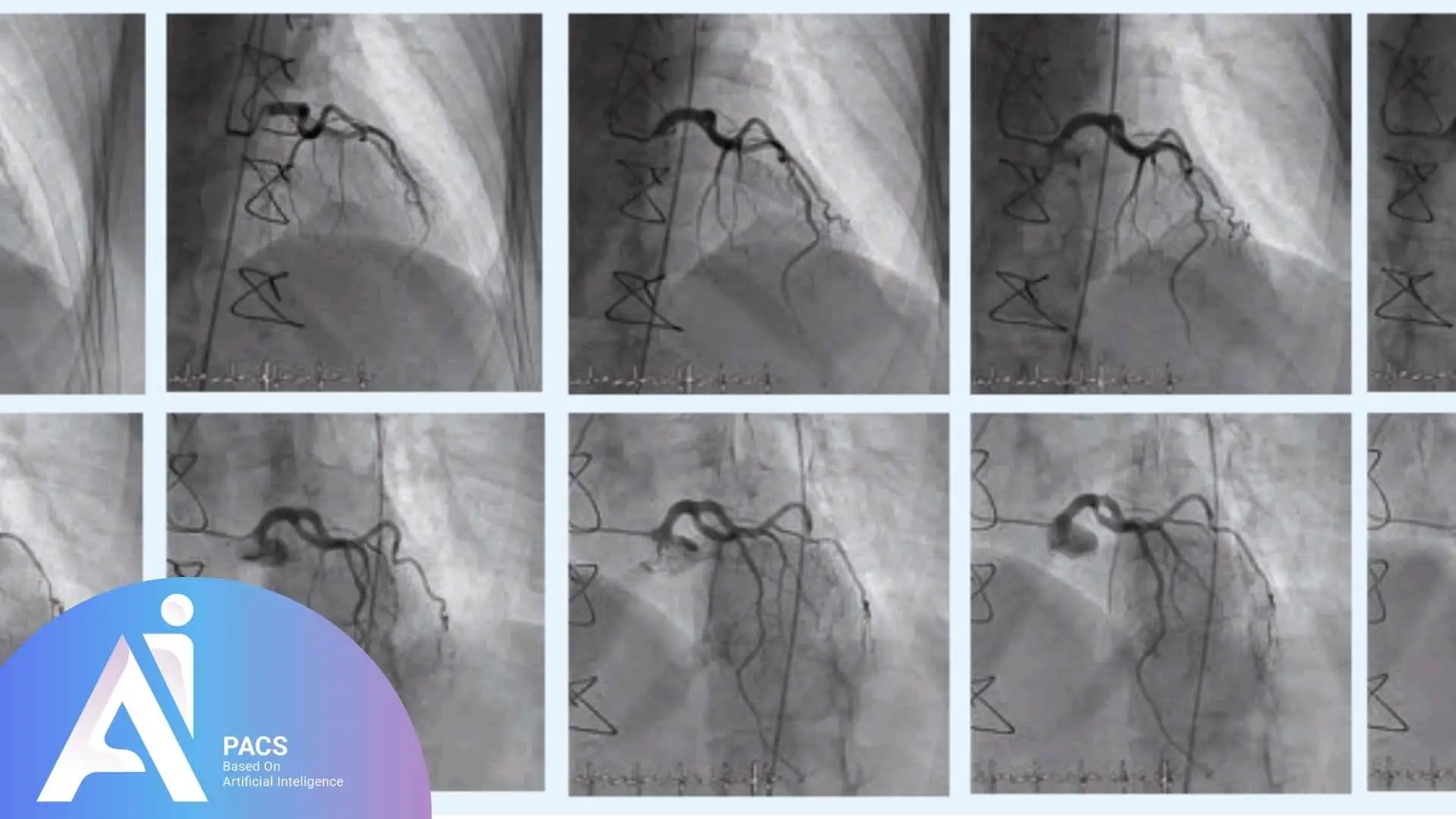 Fluoroscopy showing catheter placement in blood vessel