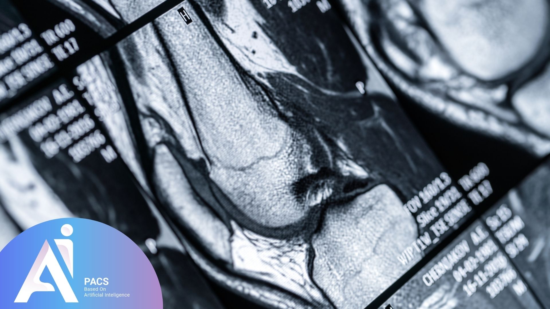 How to Read Your Knee MRI Report