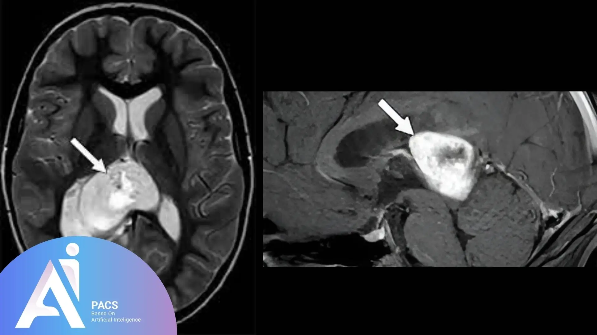Medical Imaging for Headaches on CT scan