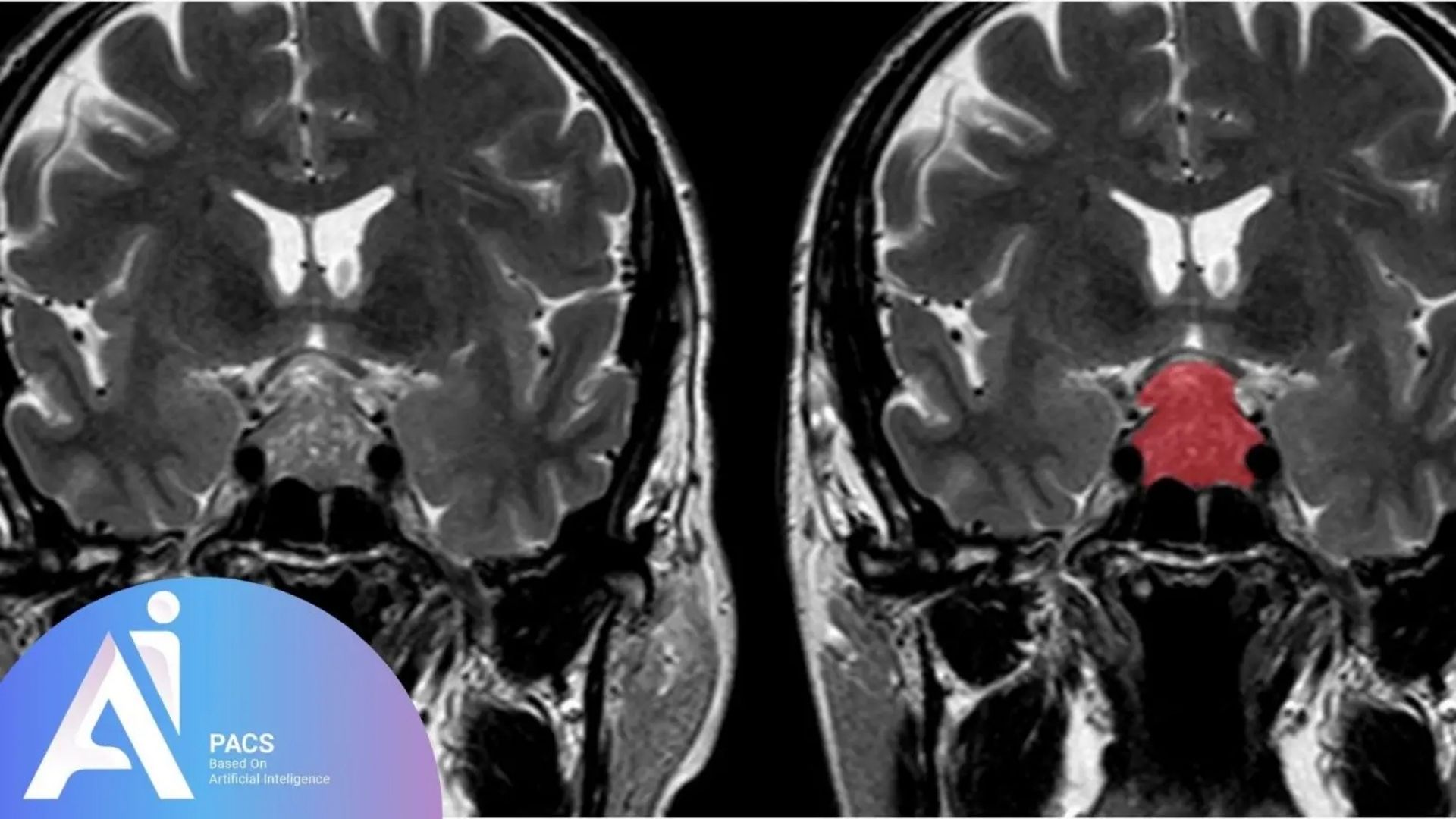 a close-up of a MRI scan from pituitary macro adenomas