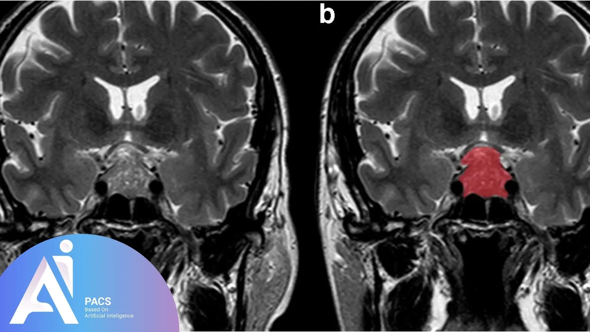a close-up of a mri scan from pituitary adenomas a close-up of a mri scan from pituitary adenomas