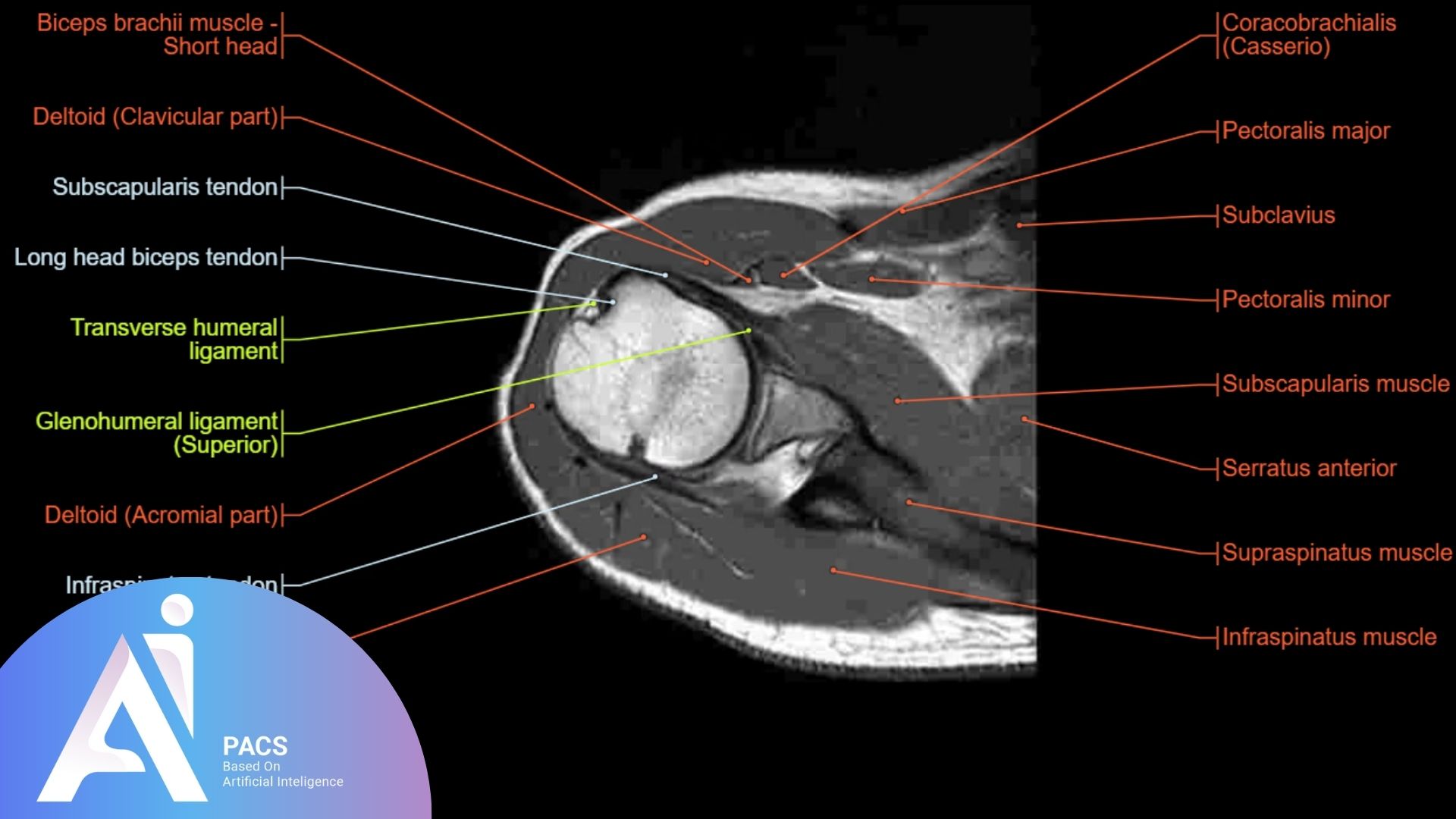 shoulder MRI Terms on anatomy image