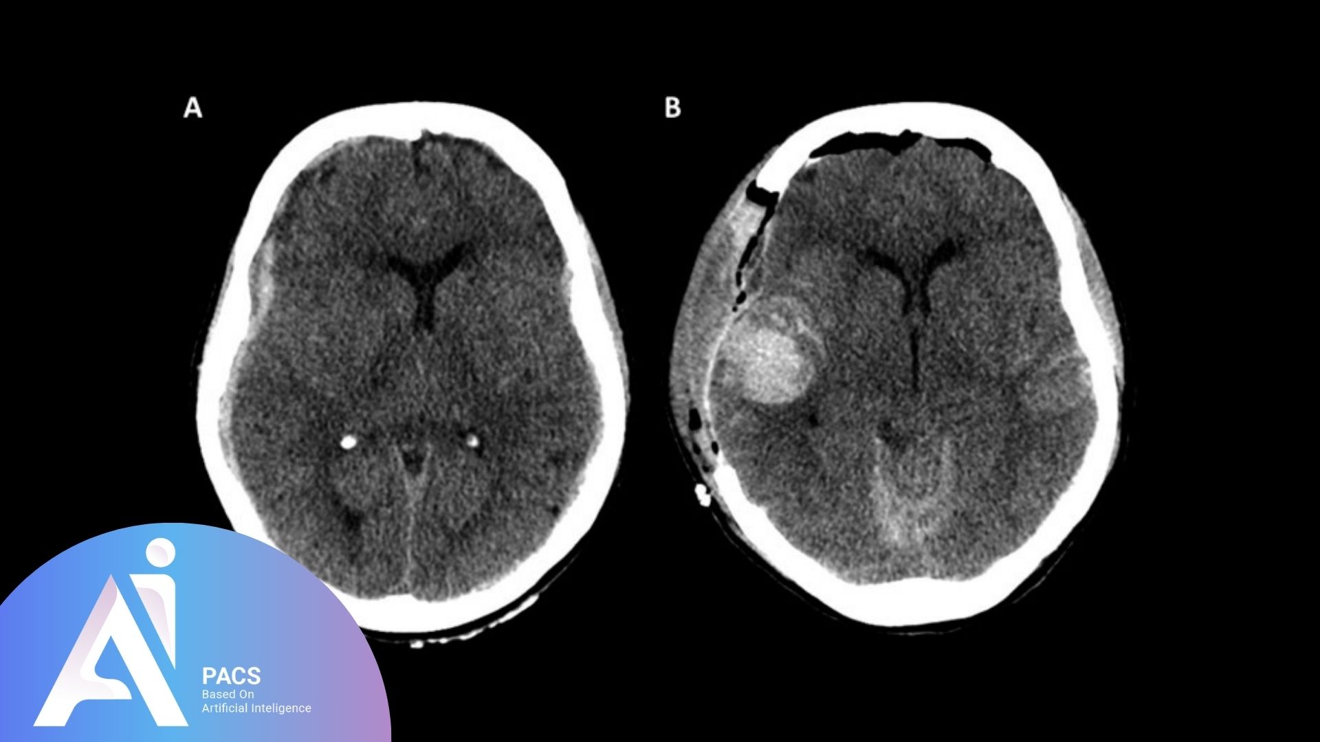MRI and CT scan Imaging Traumatic Brain Injuries