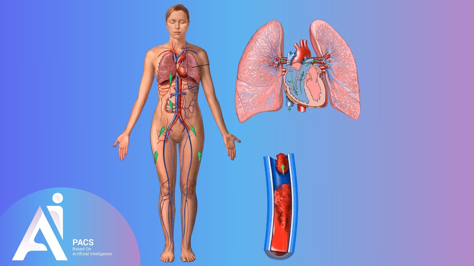 what is thrombosis in human body