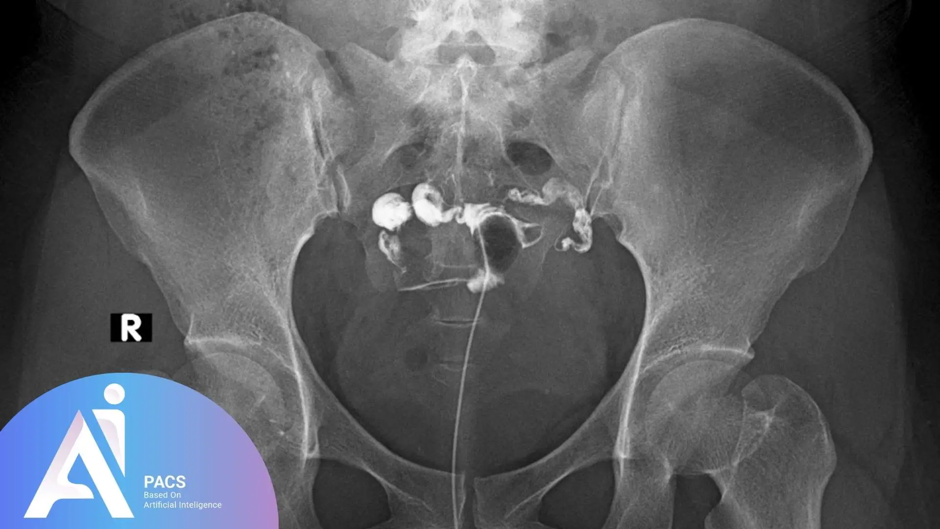 Hysterosalpingography 