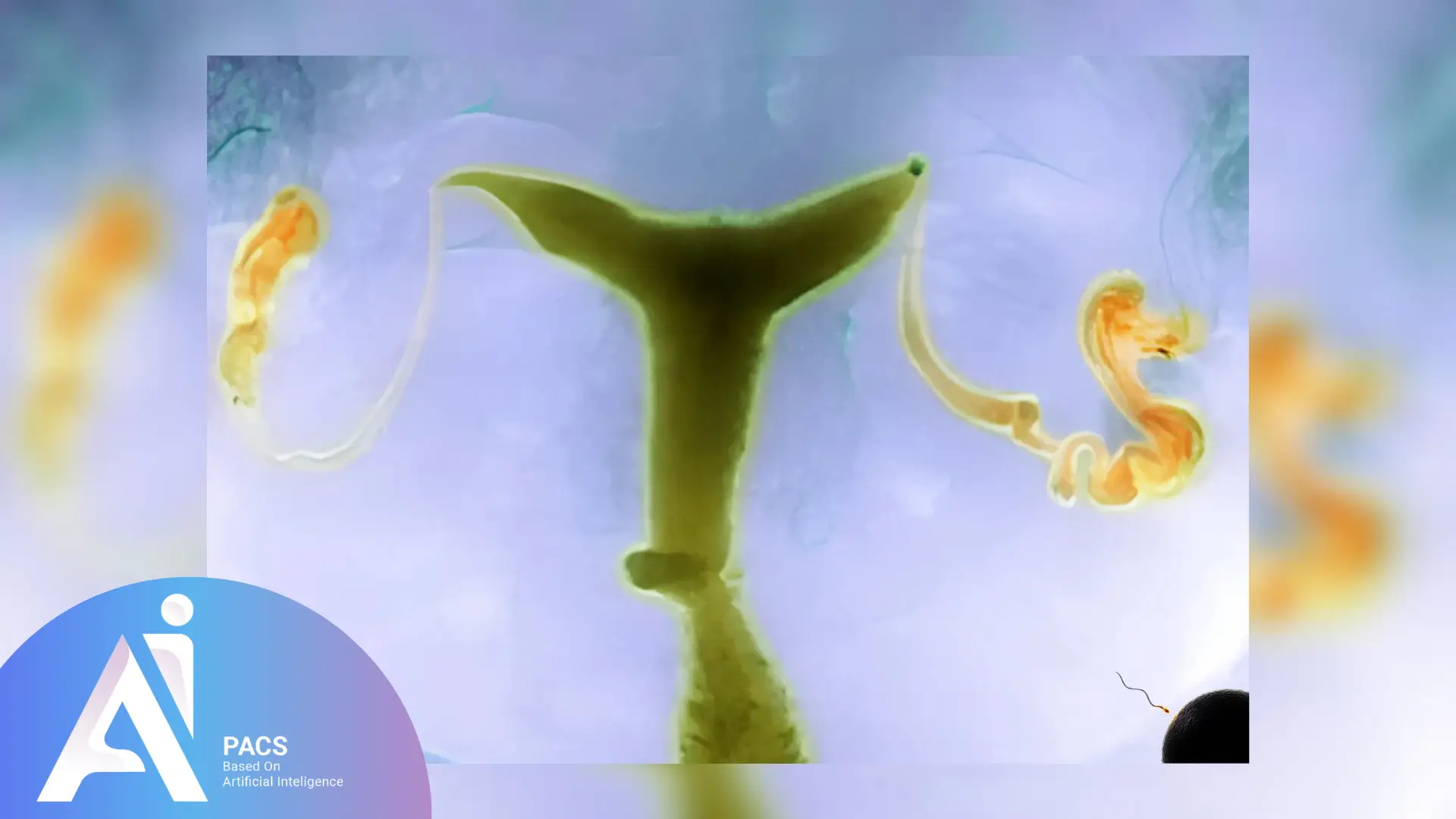 Hysterosalpingography (HSG): The Key to Understanding Fertility