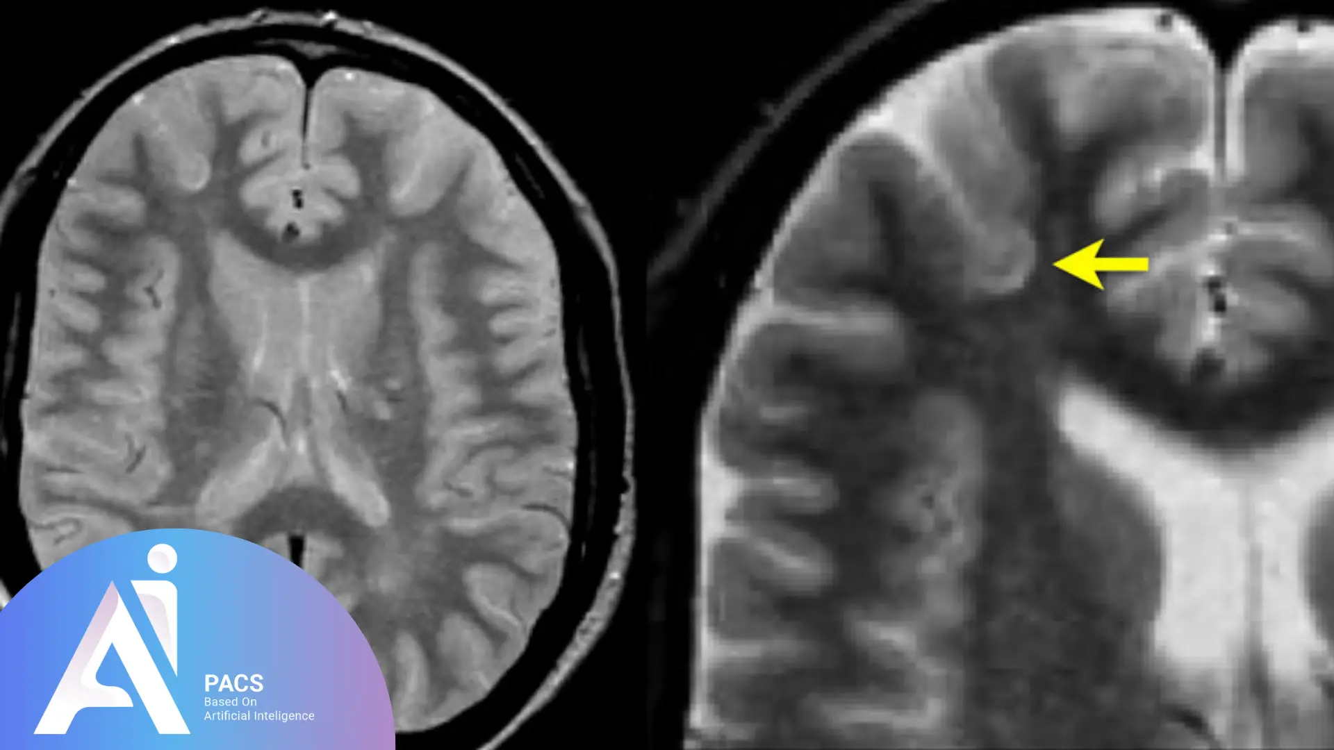 MS Brain MRI Report – What Does My Report Say? Juxtacortical Lesions