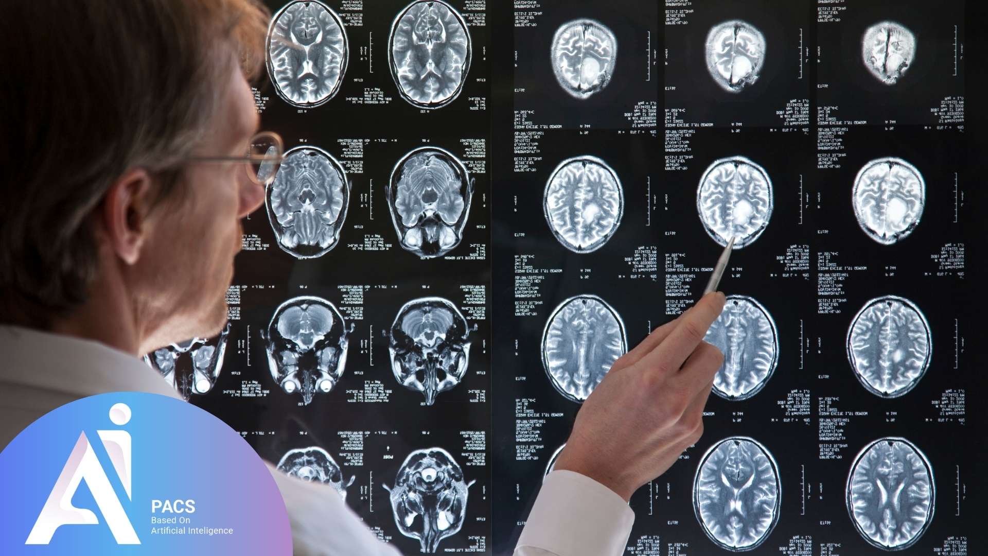 MS brain MRI report