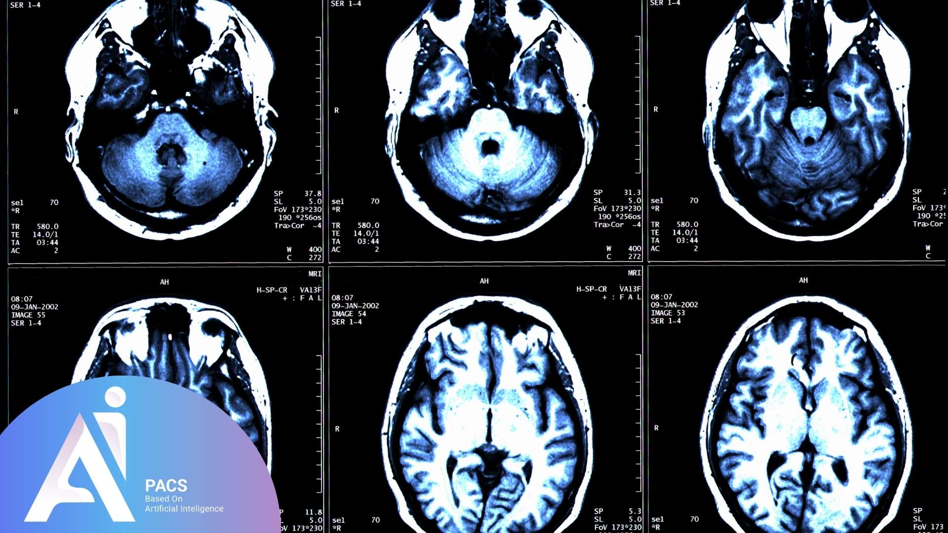 MS brain MRI report