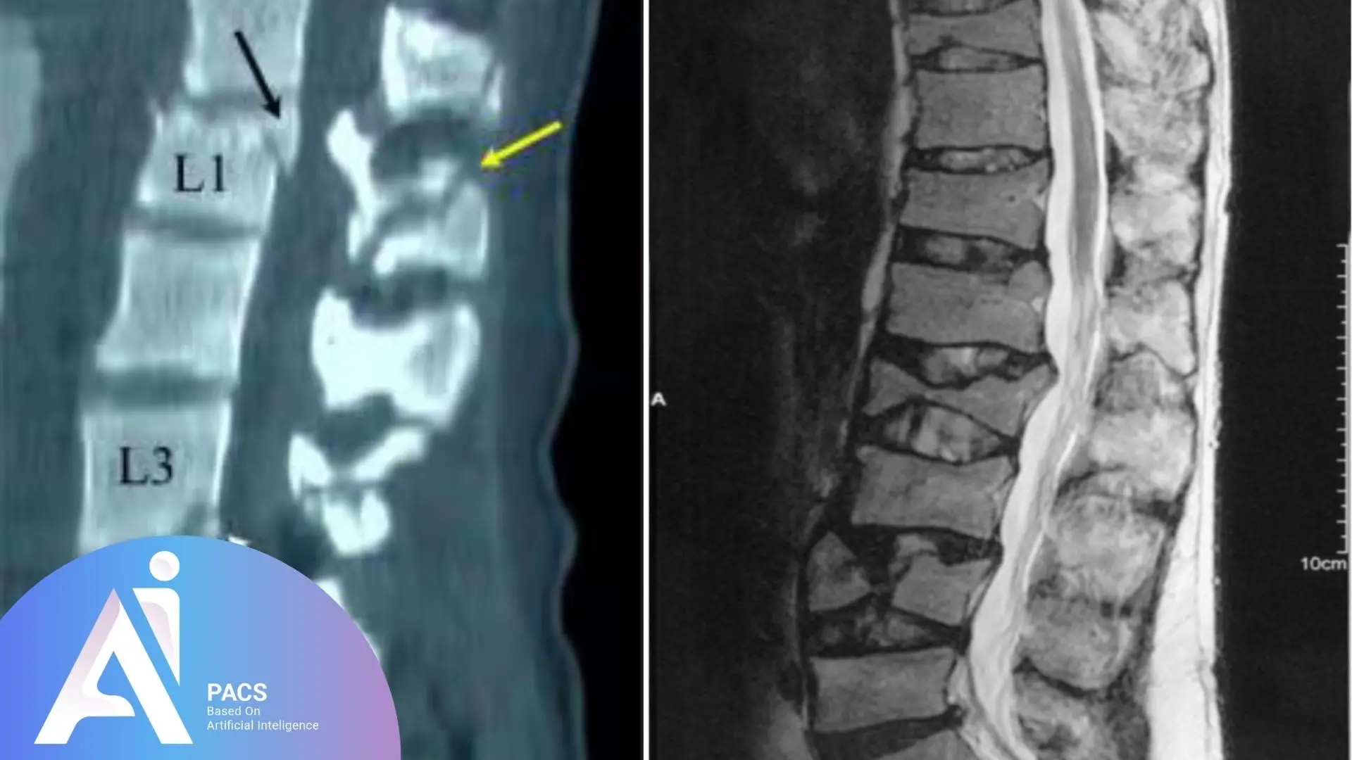 Lumbar spine trauma on MRI imaging which second opinion showed Fractures