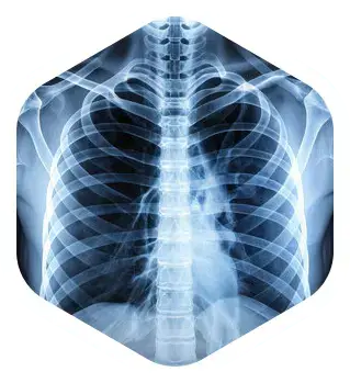 chest ct 2 1