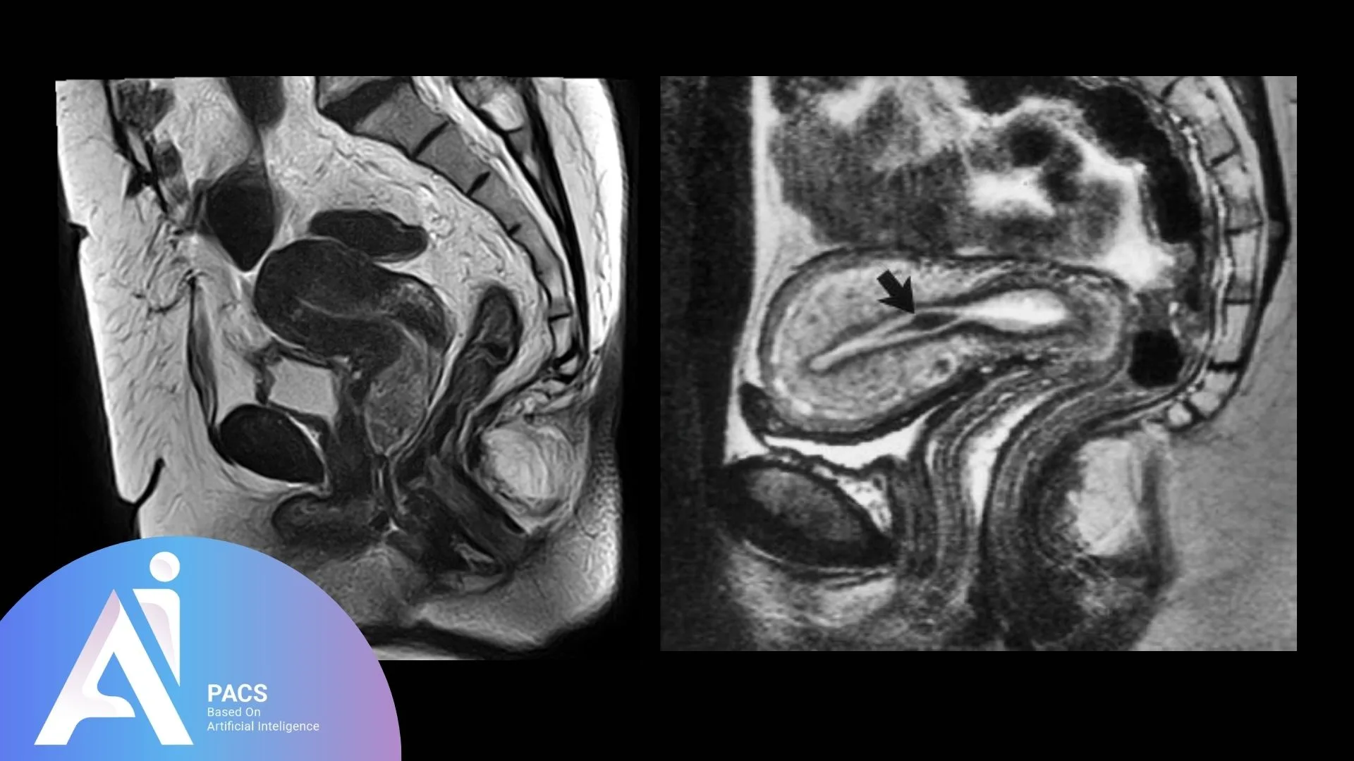 Abnormal Uterine Bleeding (AUB) MRI Imaging