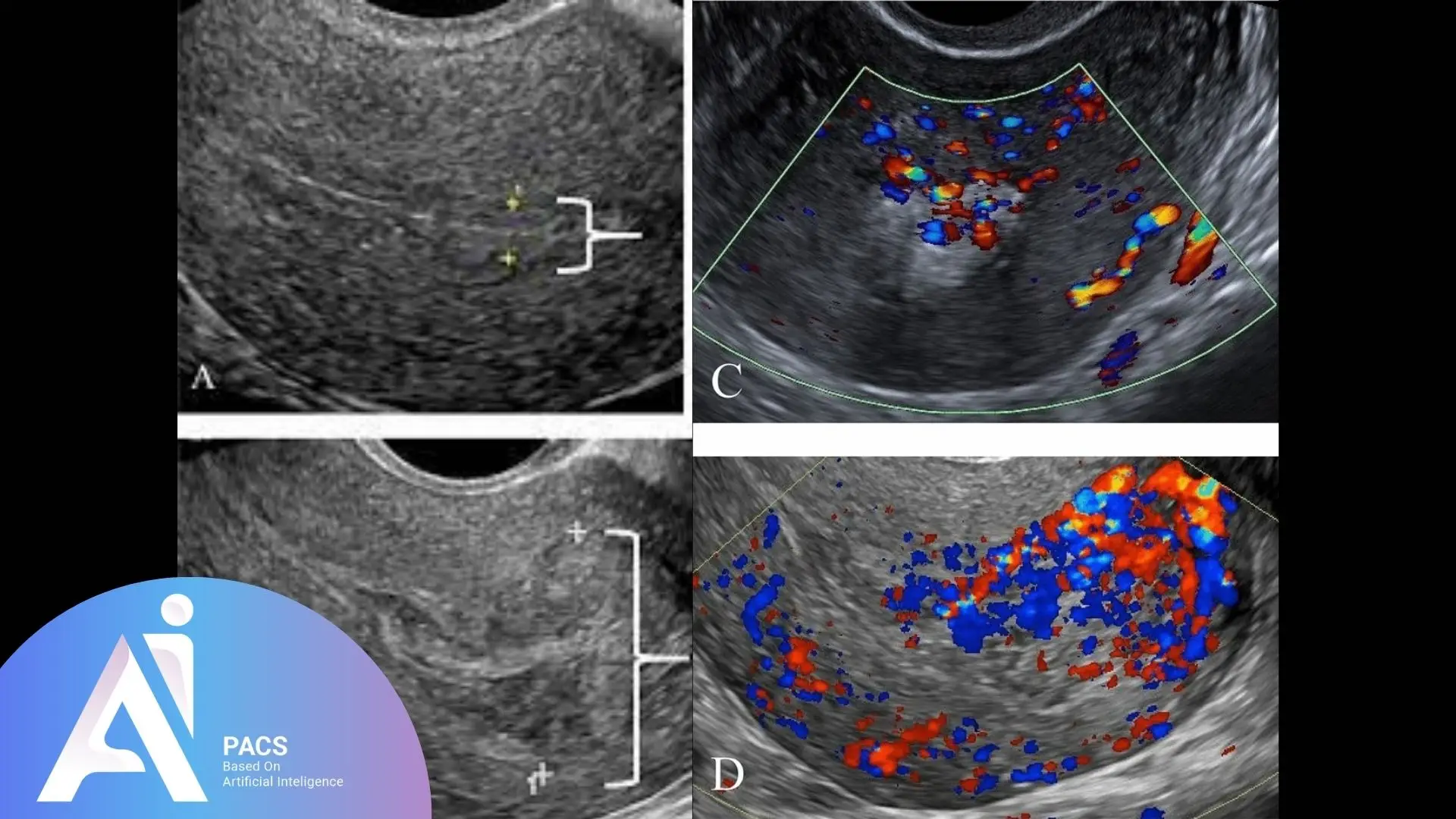 Abnormal Uterine Bleeding (AUB) Transvaginal ultrasound Imaging 